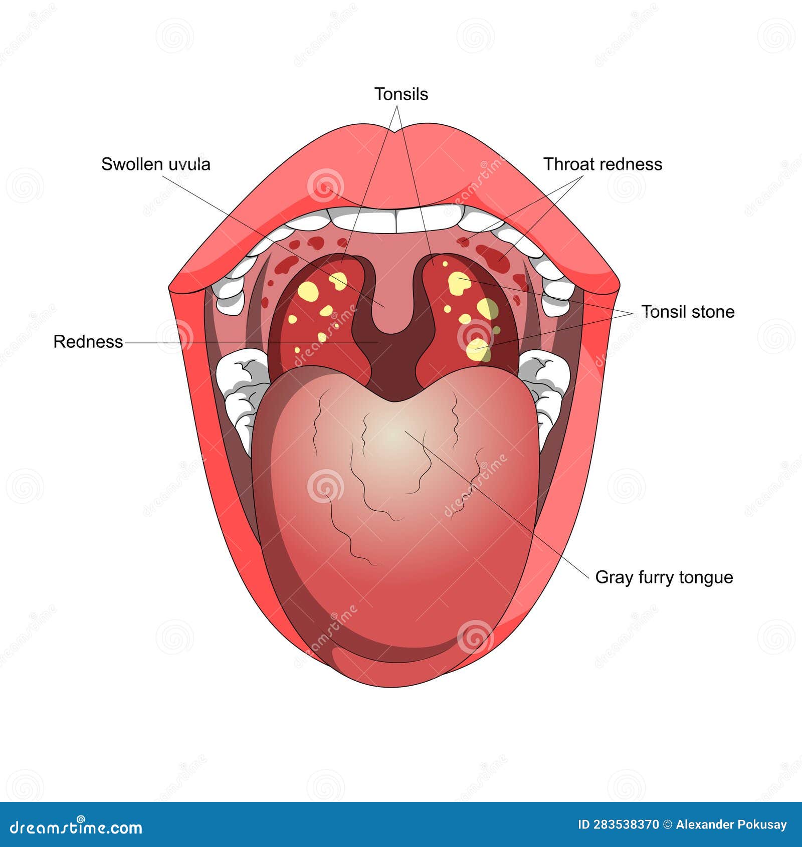 Tonsillitis Diagram Medical Science Royalty-Free Cartoon ...