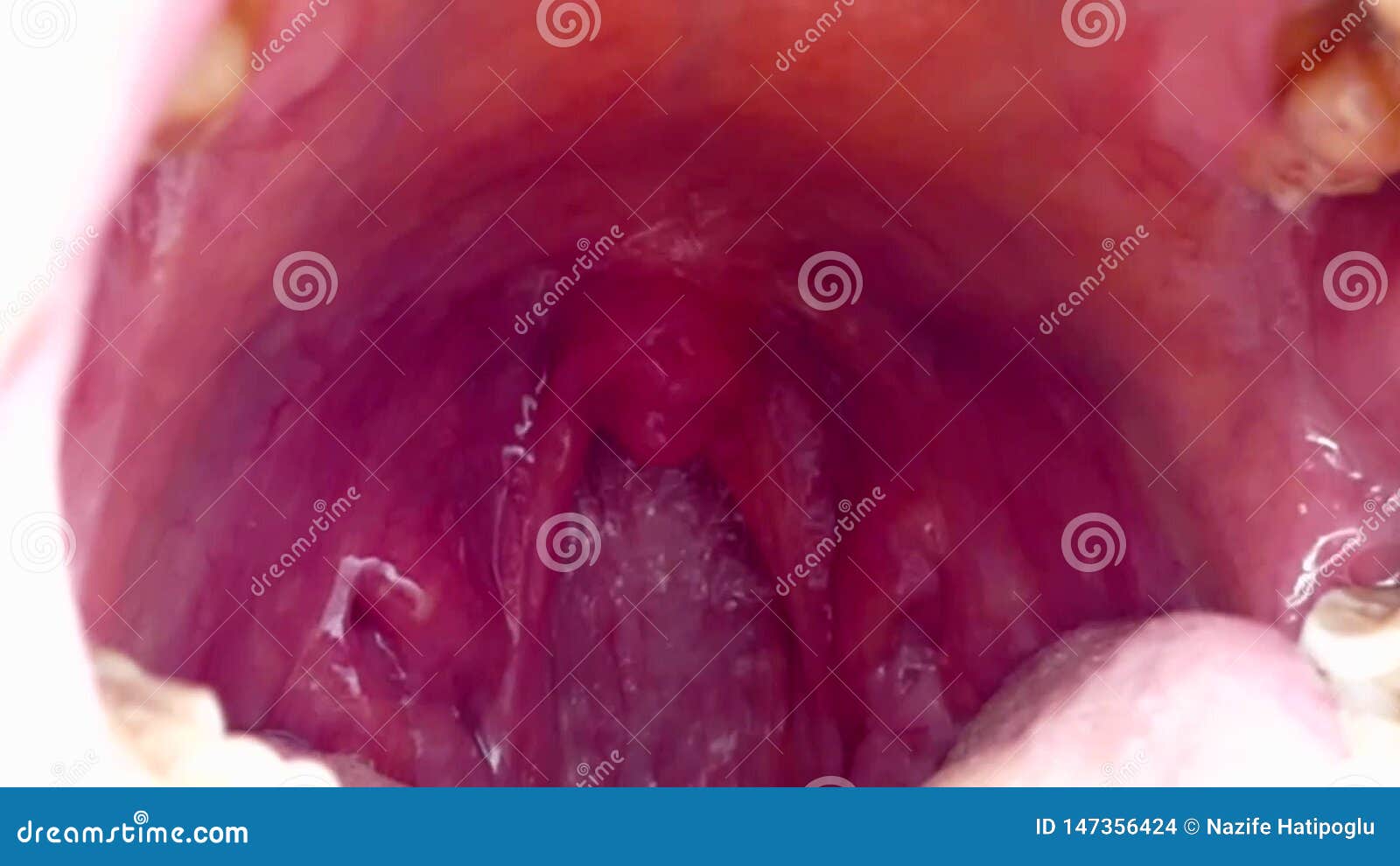 Tonsils Deformed, Tonsillitis, Neglected Poor Human Mouth Interior, a