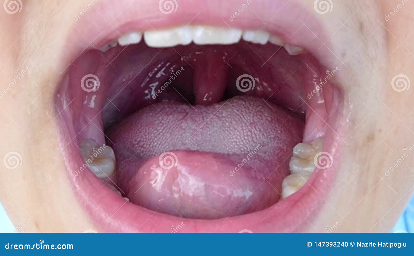 Tonsillitis Stock Footage & Videos 171 Stock Videos