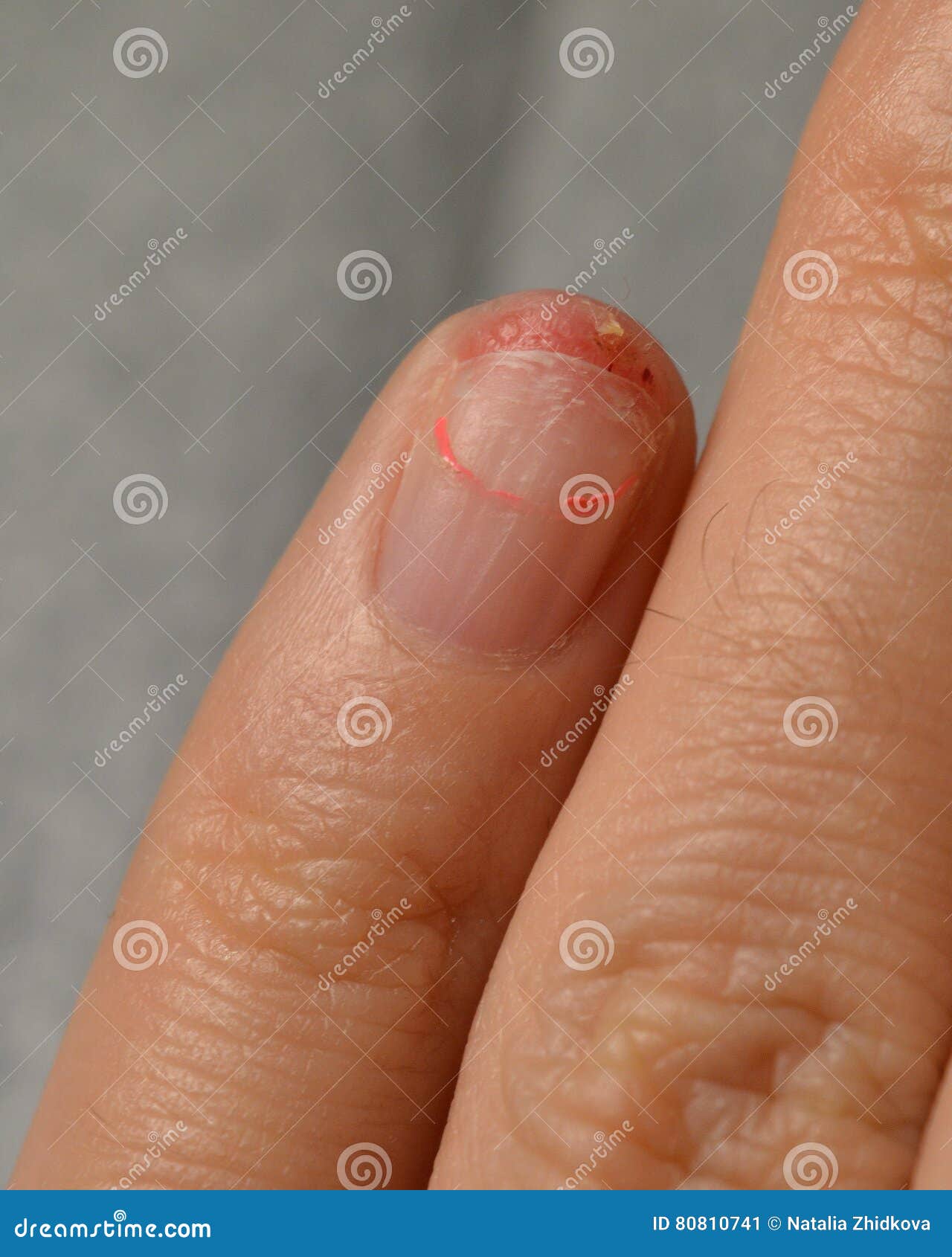 Too Grown Nail Gel-coated Break Off and Injure the Skin Under the Nail Plate  Stock Image - Image of break, fixation: 80810741
