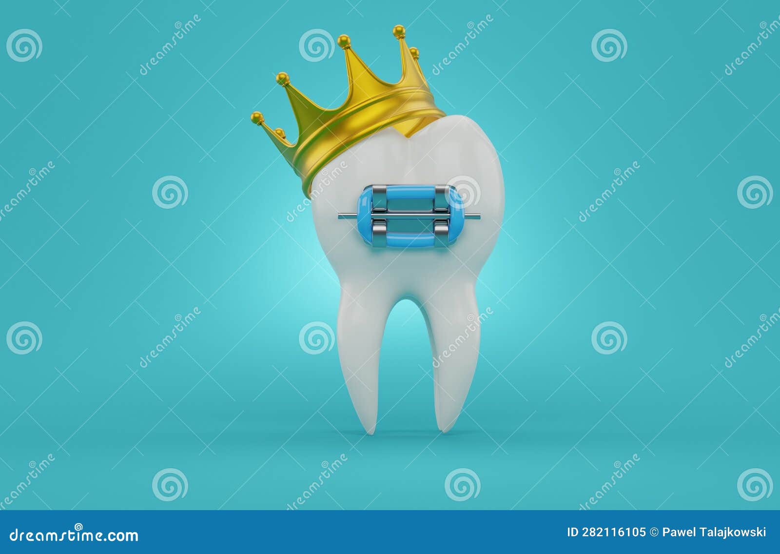 Tooth with brace and crown stock illustration. Illustration of blue