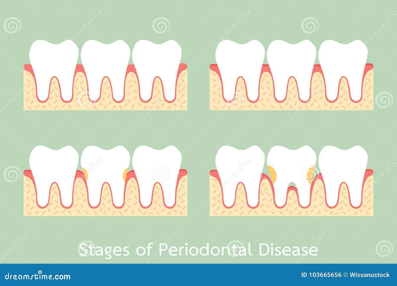 step of periodontal disease / periodontitis / gingivitis / gum disease, dental problem