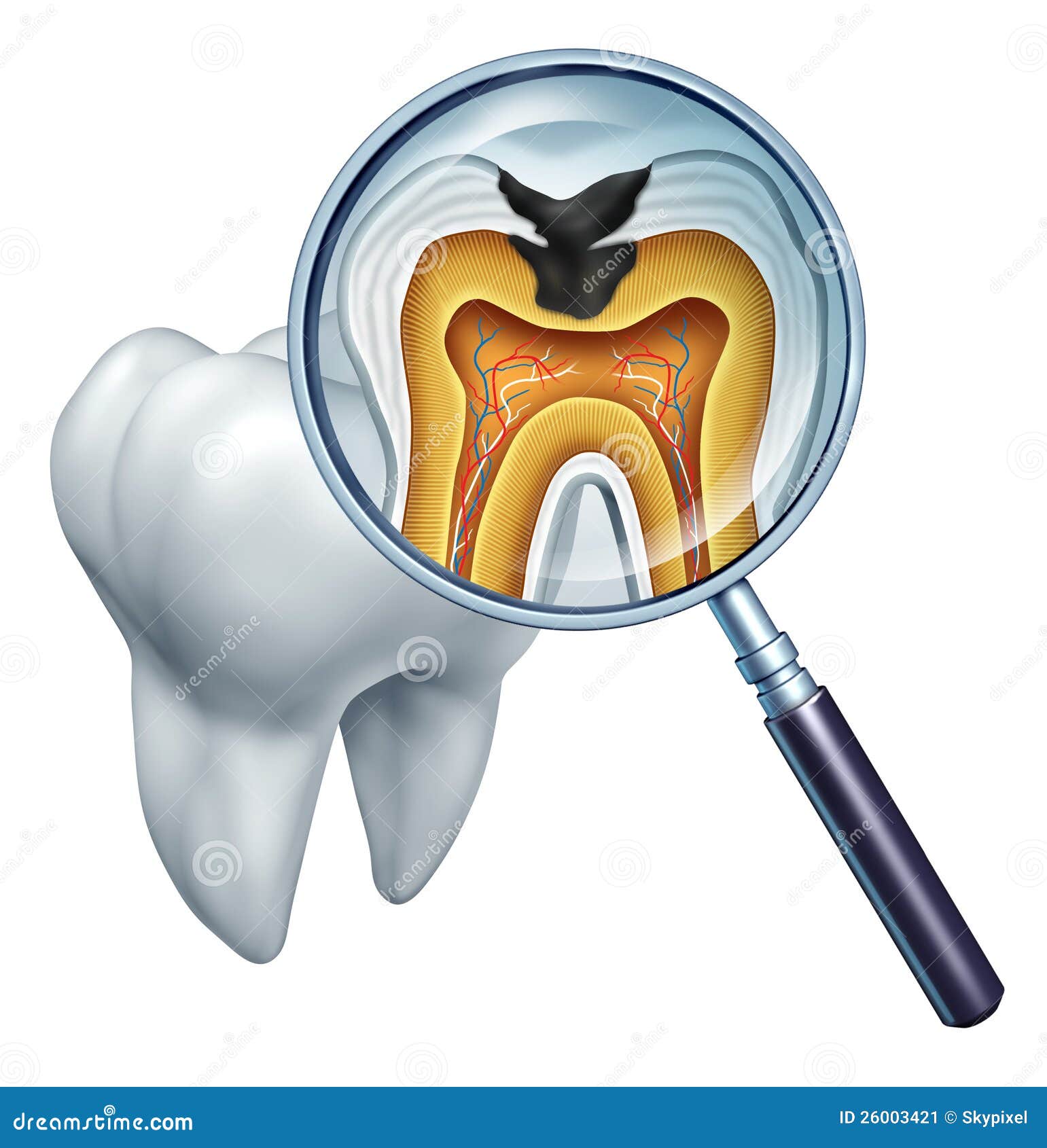 tooth cavity close up