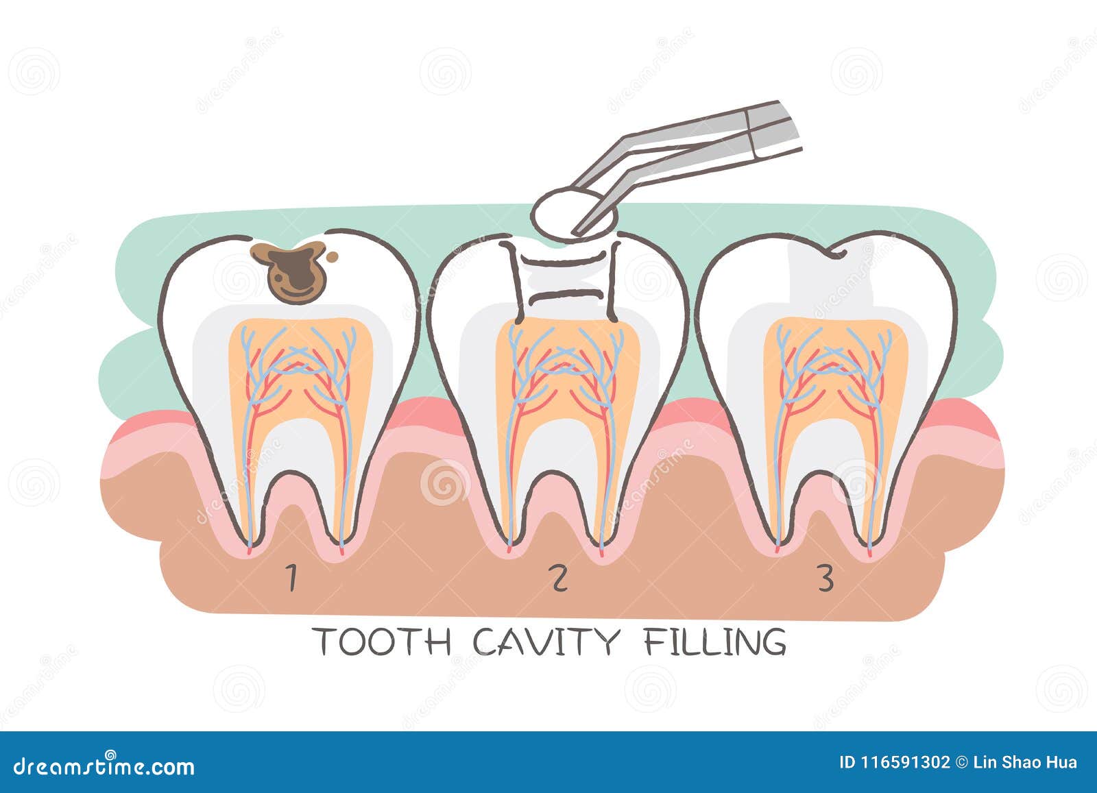 tooth cavity filling