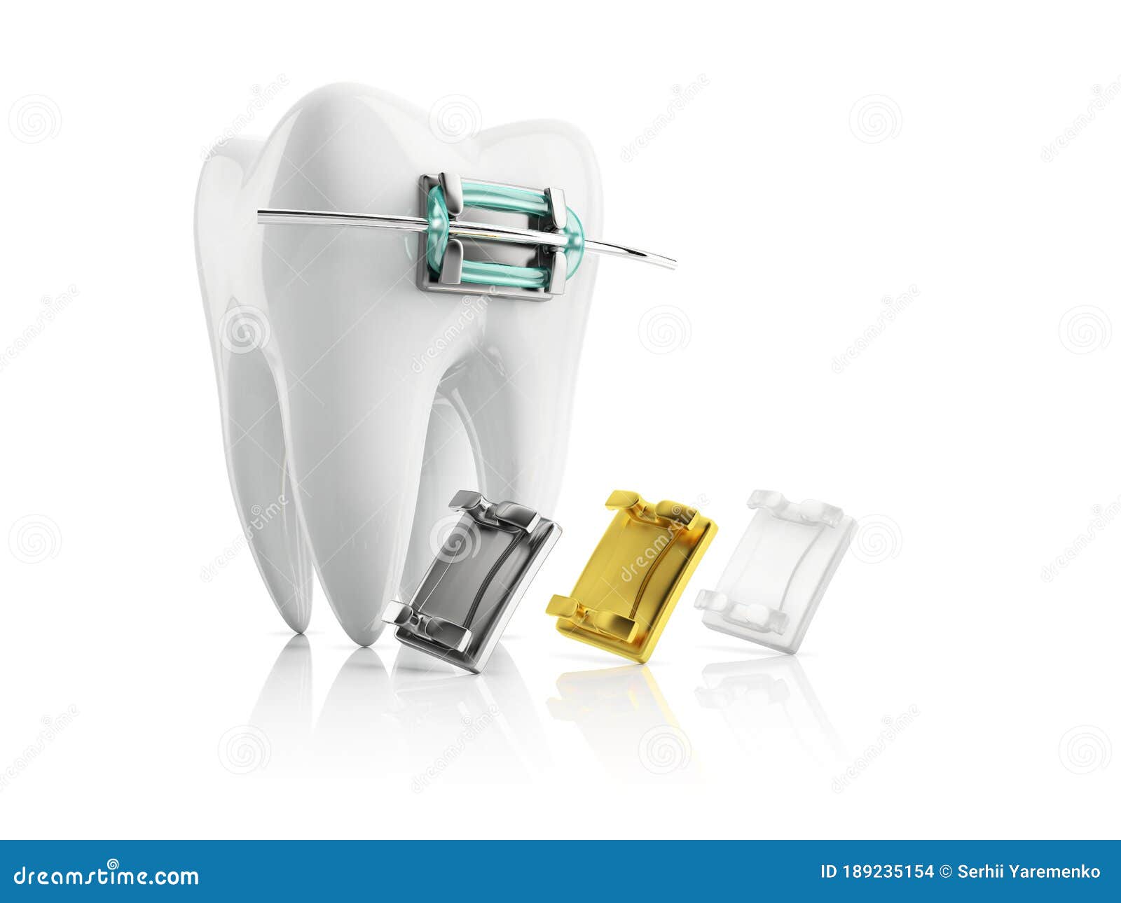 Tooth metal bracket stock illustration. Illustration of teeth 189235154
