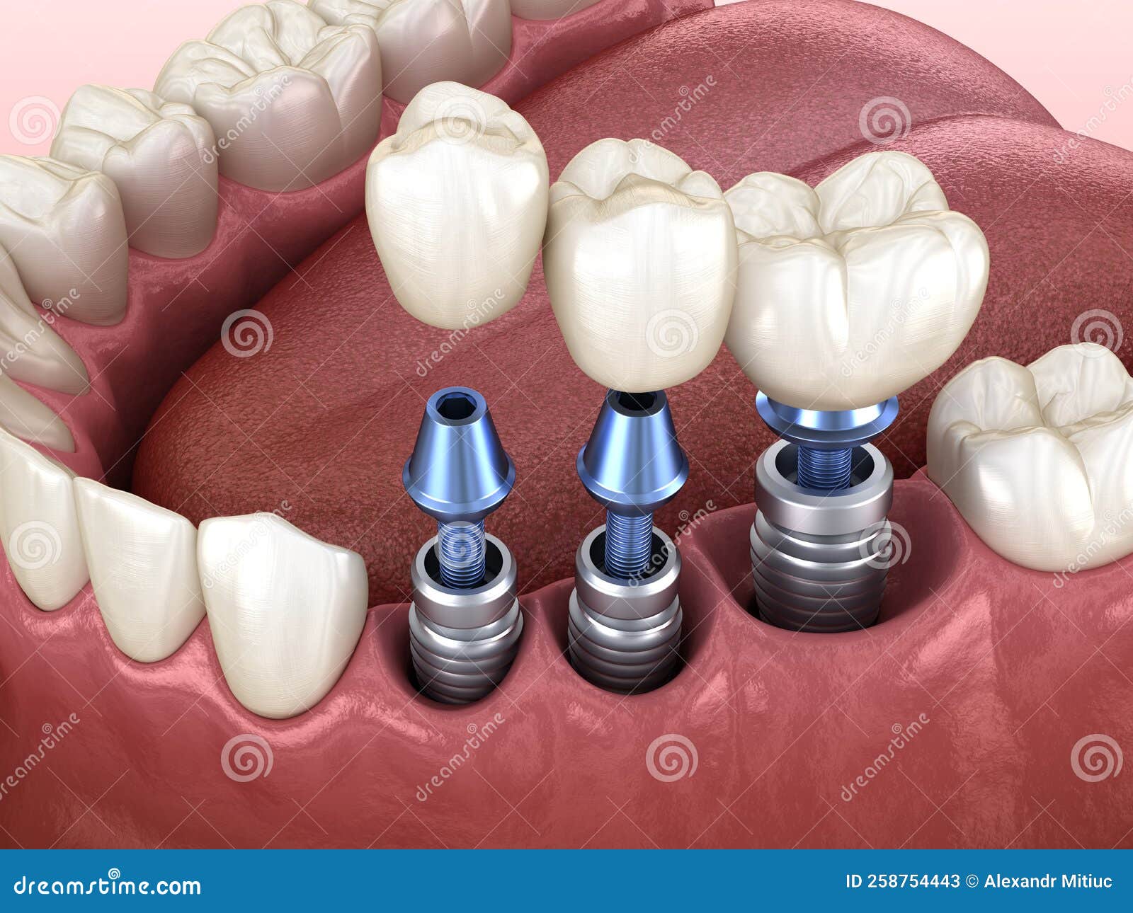 3 Tooth Crowns Placement Over 3 Implants Concept. 3D Illustration of