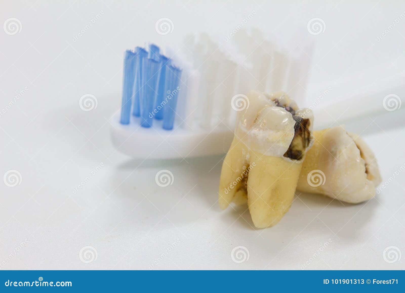 Tooth Decay Dental Caries and Tooth Brush Stock Image Image of caries, molar 101901313