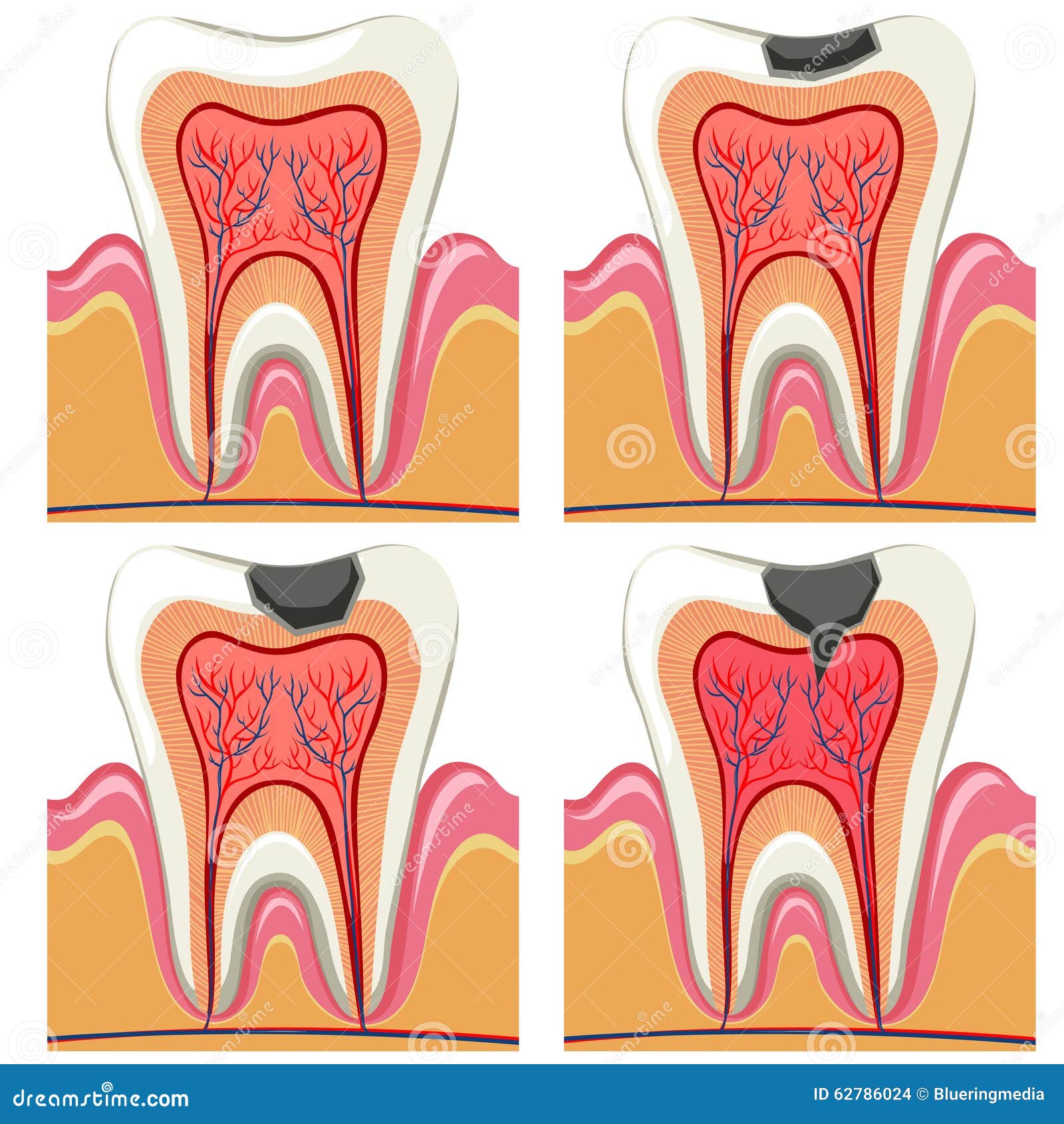 clipart tooth decay - photo #44