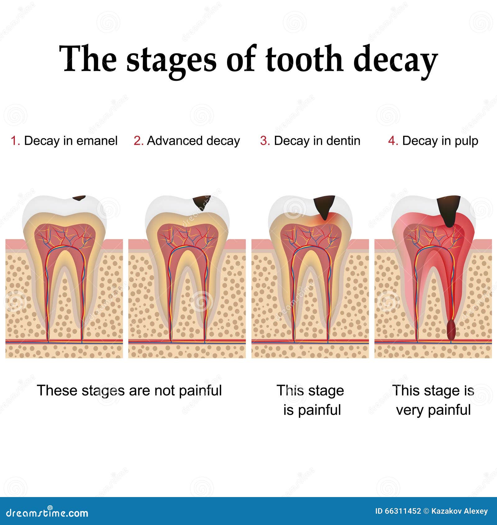 tooth decay formation