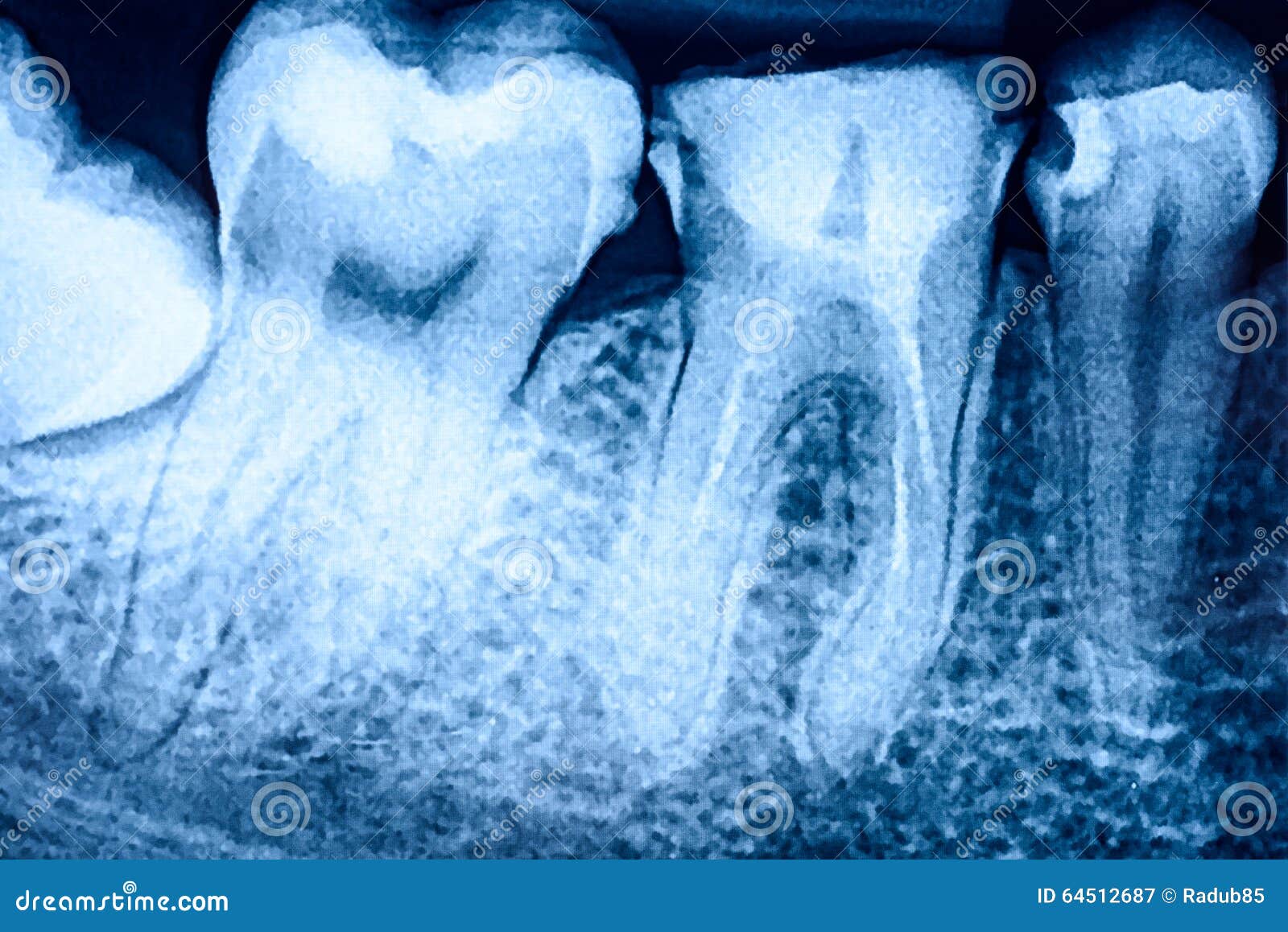 tooth decay on x-ray