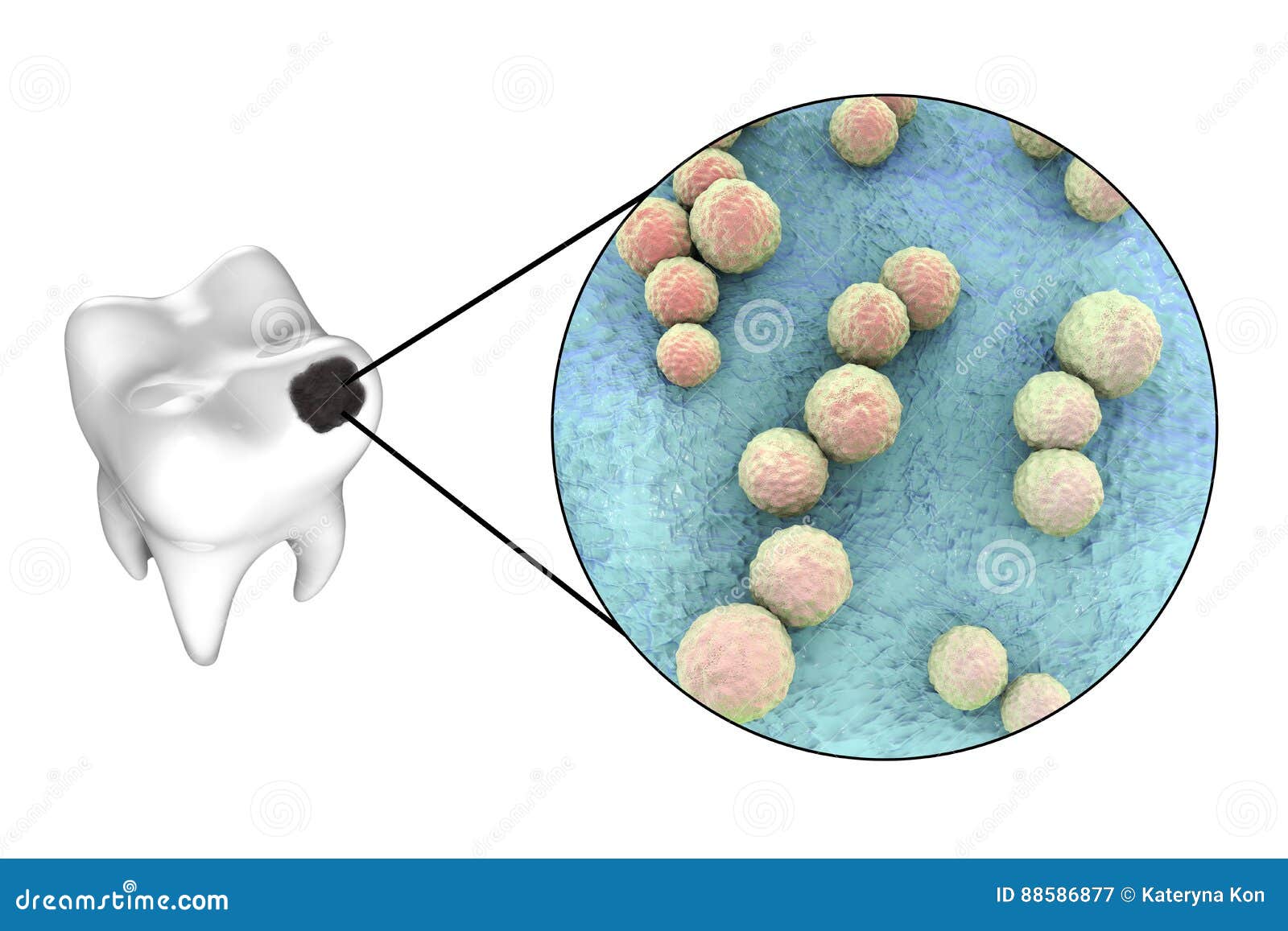 Dental Caries Bacteria Stock Photo 18710826