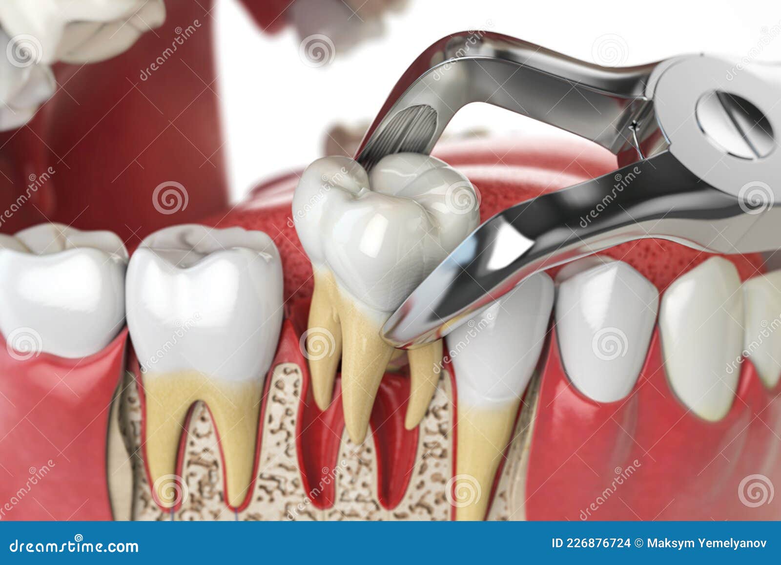 tooth extraction by dental forceps on model of human jaw.