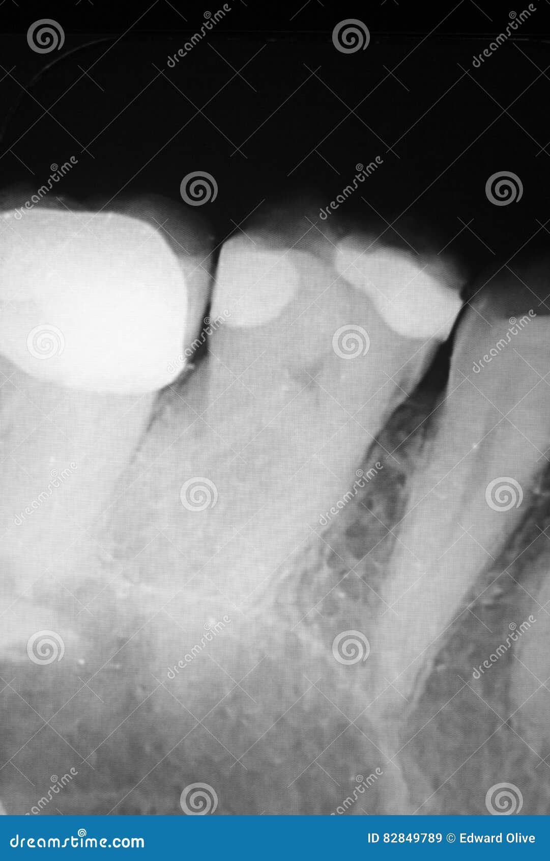 Tooth filling dental xray. Tooth with filling dental x-ray close-up image showing teeth roots, gum disease and tooth decay to enamel.