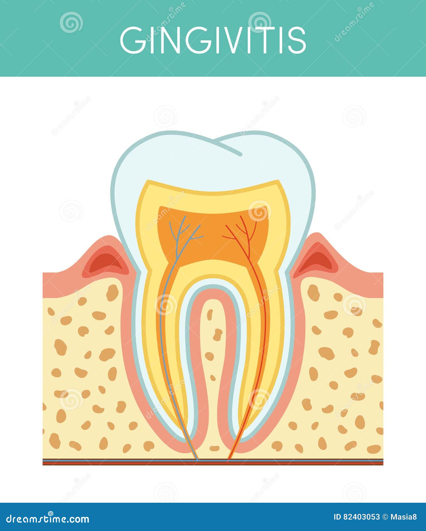 tooth with gingivitis