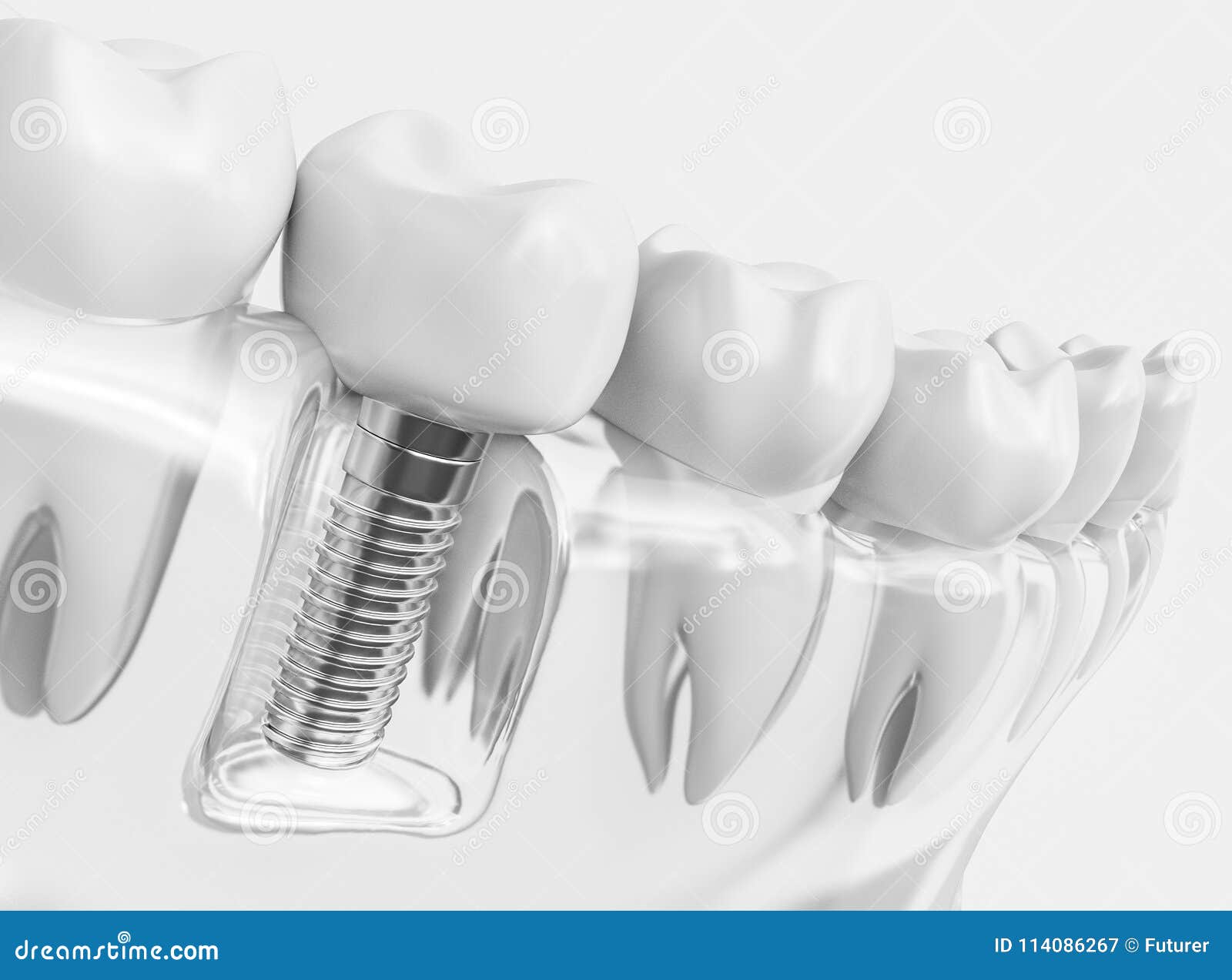 tooth human implant - 3d rendering