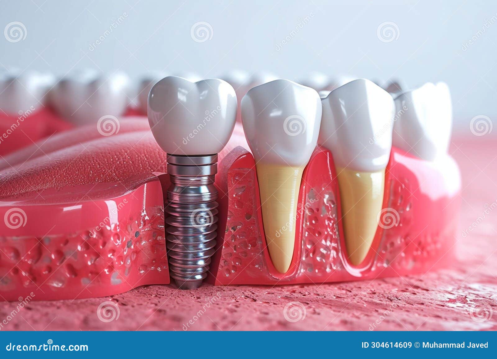 Tooth Restoration Dental Implant Procedure for Treating Gum Disease
