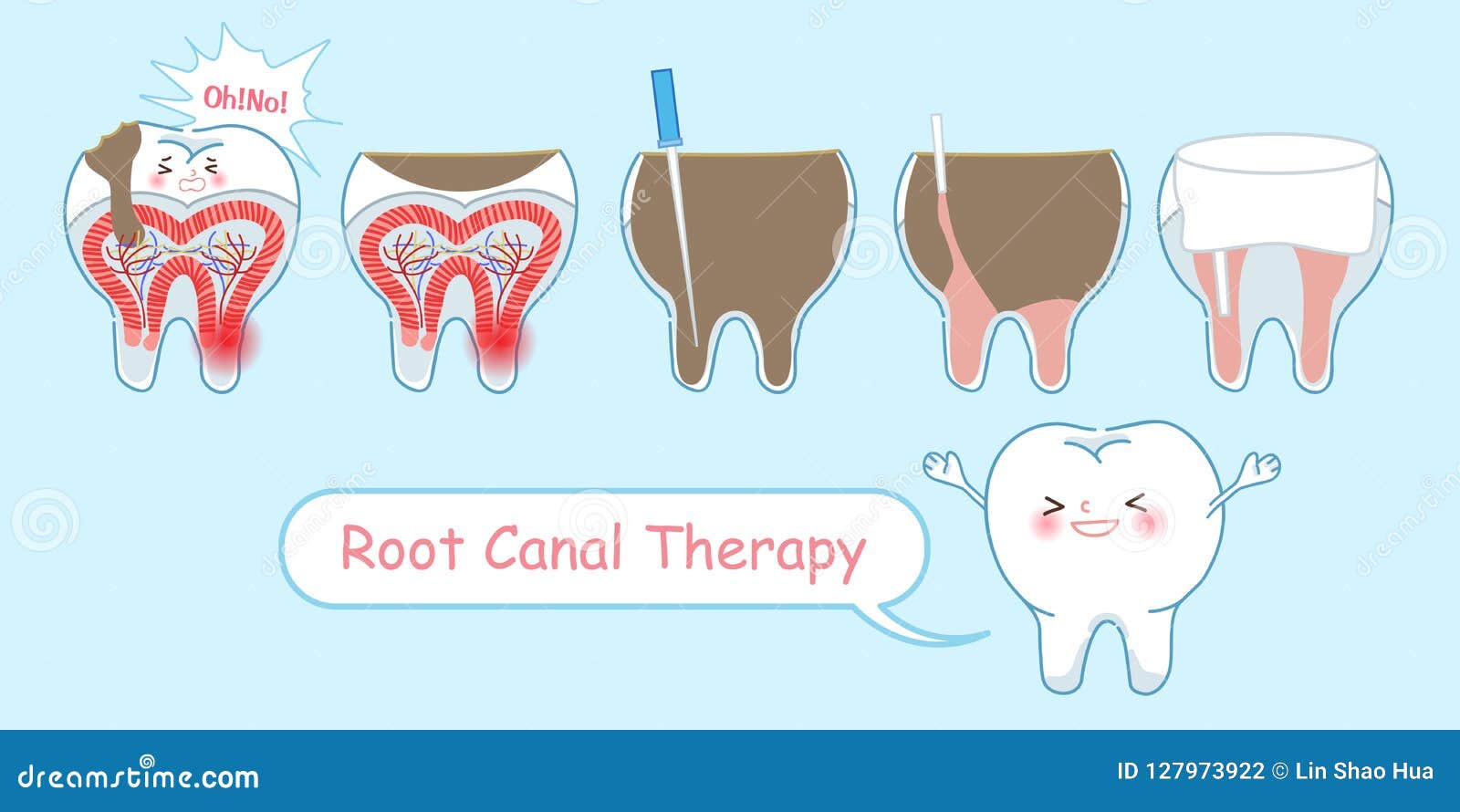 Cartoon Tooth Root Canal Treatment Stock Illustrations – 294 Cartoon Tooth Root Canal Treatment Stock Illustrations, Vectors & Clipart - Dreamstime Cartoon Tooth Root Canal Treatment Stock Illustrations – 294 Cartoon Tooth Root Canal Treatment Stock Illustrations, Vectors & Clipart - Dreamstime