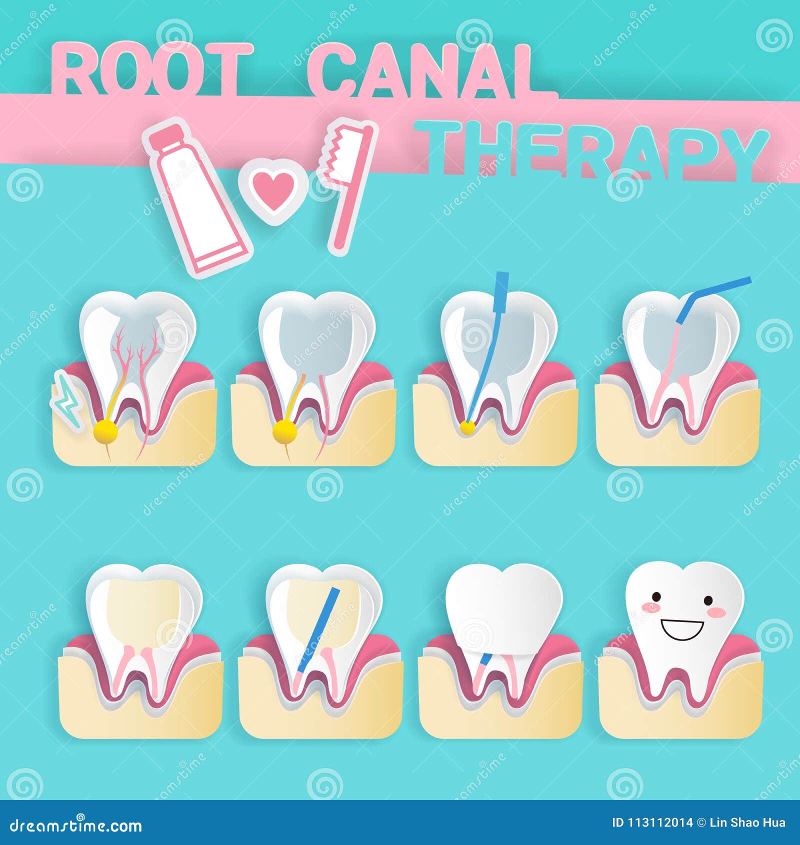 Cartoon Tooth Root Canal Treatment Stock Illustrations – 294 Cartoon Tooth Root Canal Treatment Stock Illustrations, Vectors & Clipart - Dreamstime Cartoon Tooth Root Canal Treatment Stock Illustrations – 294 Cartoon Tooth Root Canal Treatment Stock Illustrations, Vectors & Clipart - Dreamstime