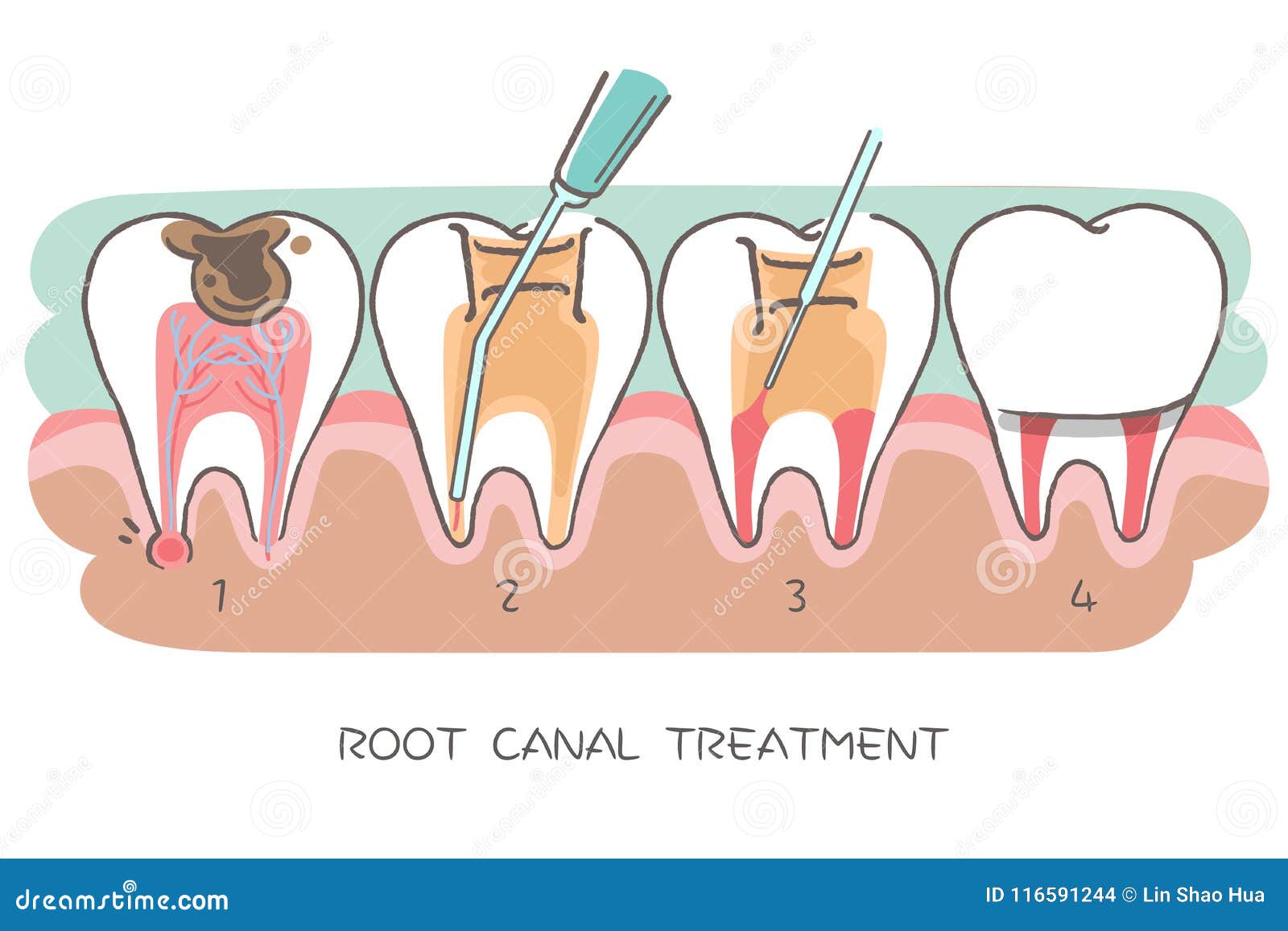 tooth with root canal treatment