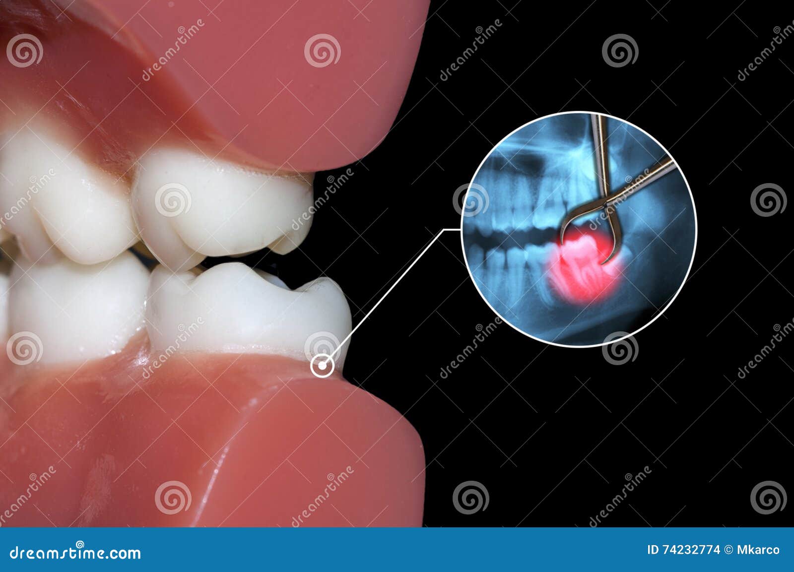 Tooth Surgical Extraction Dental Graphic Stock Photo Image of molar