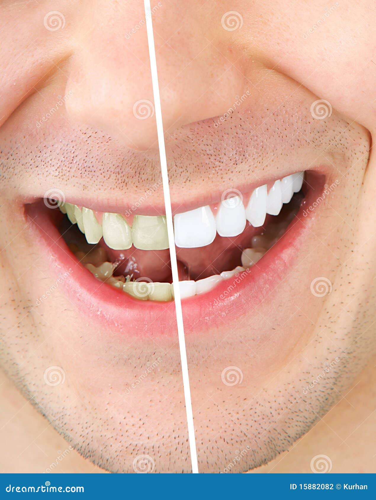 Tooth Whitening Stock Photography - Image: 15882082