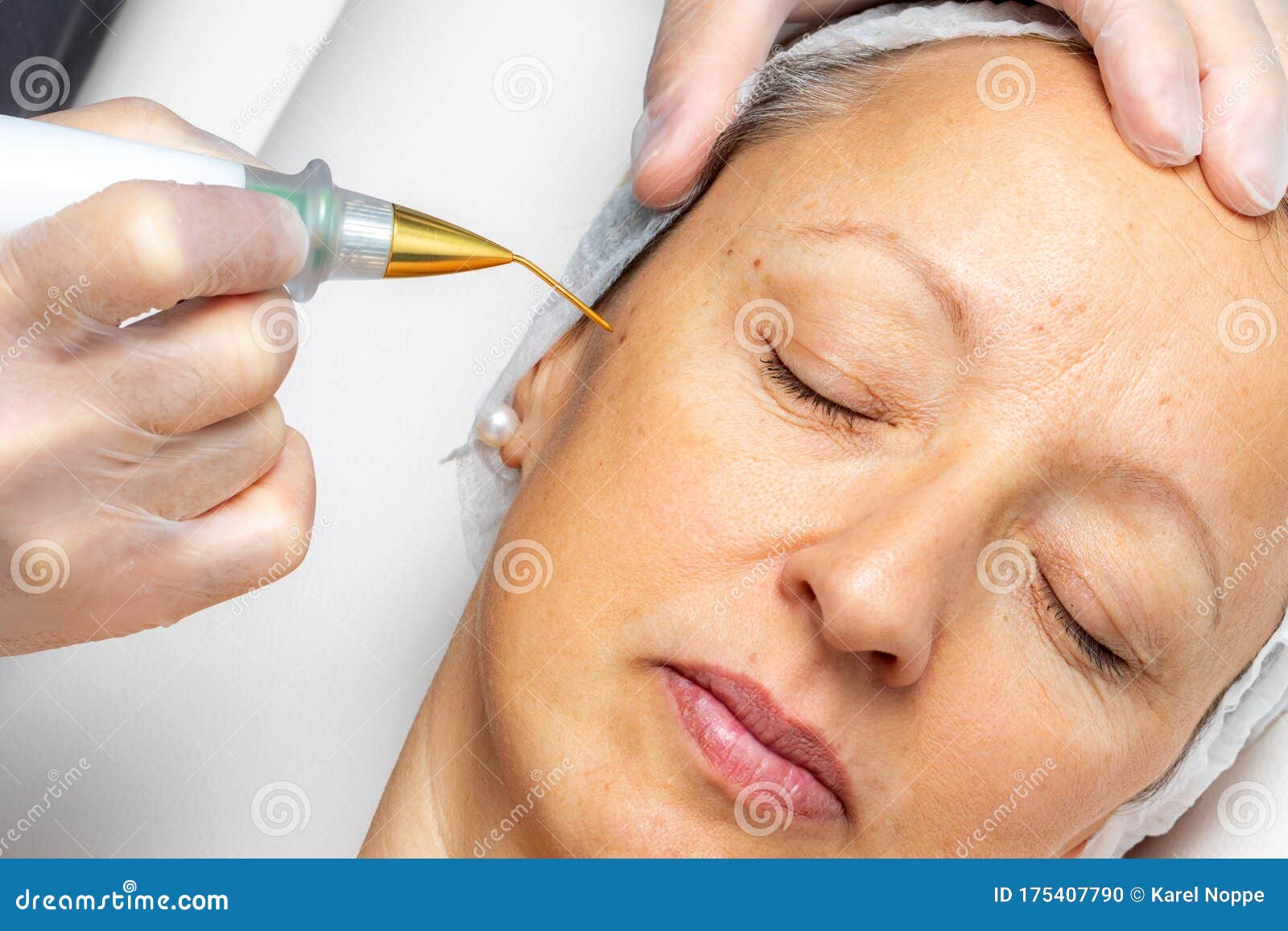 top view of laser plasma pen removing facial wart on middle aged woman