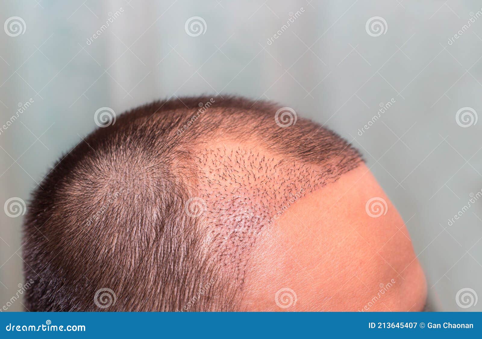 top view of a man`s head with hair transplant surgery with a receding hair line