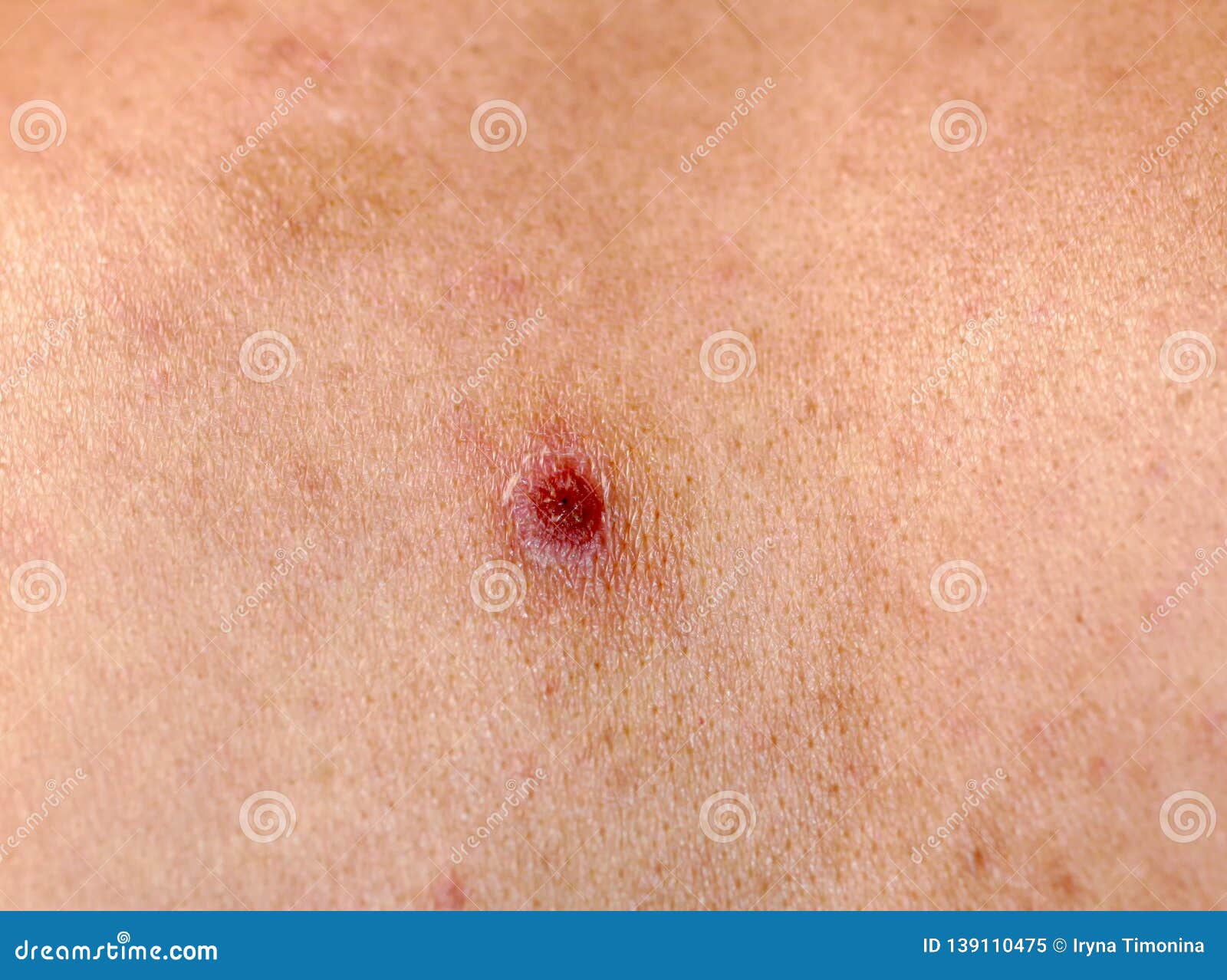 Torn Off a Bleeding Pimple on the Skin. Inflammation, Acne. Stock Image -  Image of medical, bleeding: 139110475