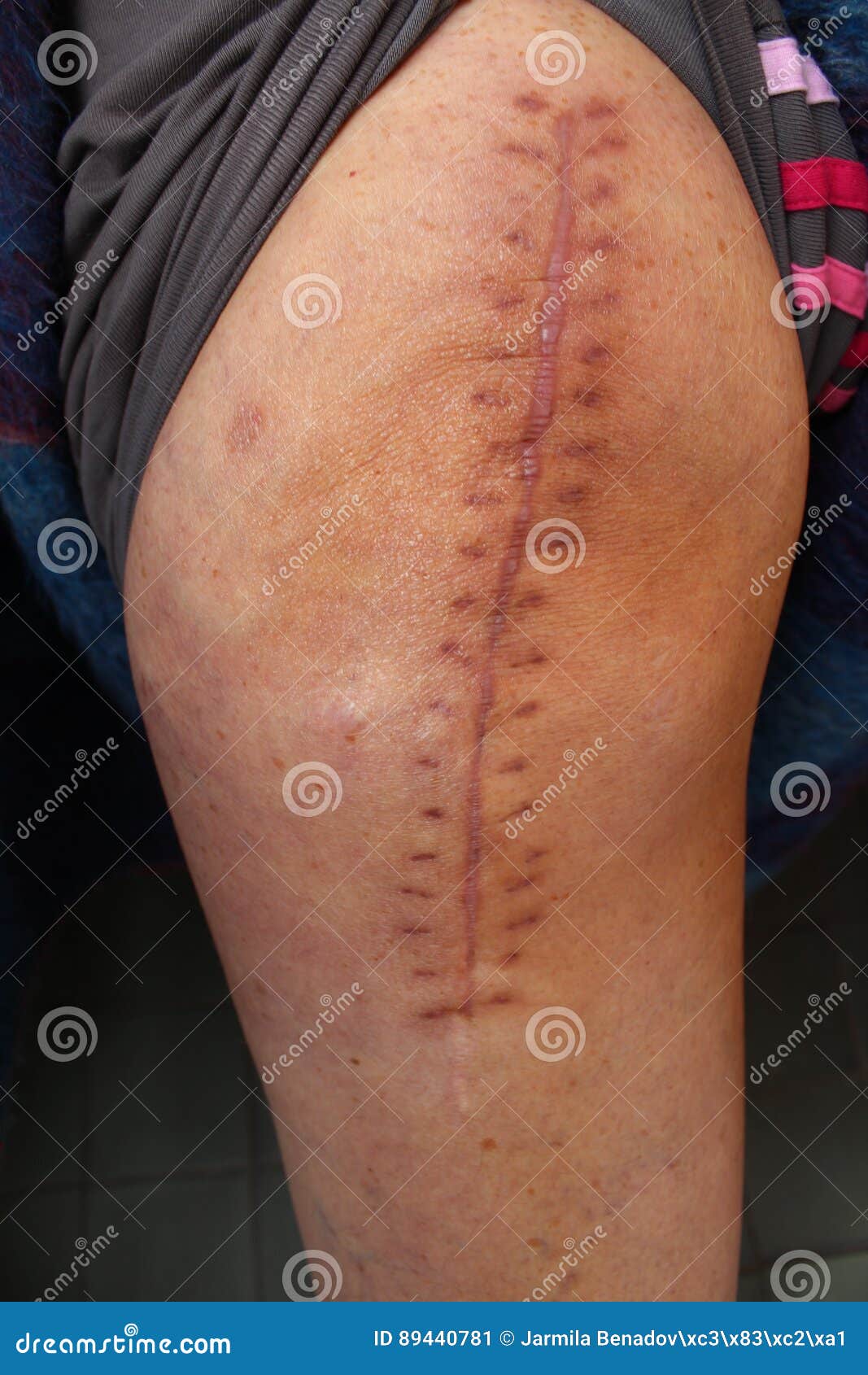 How Long Before Incision Heals After Hip Replacement How Long Before Incision Heals After Hip Replacement