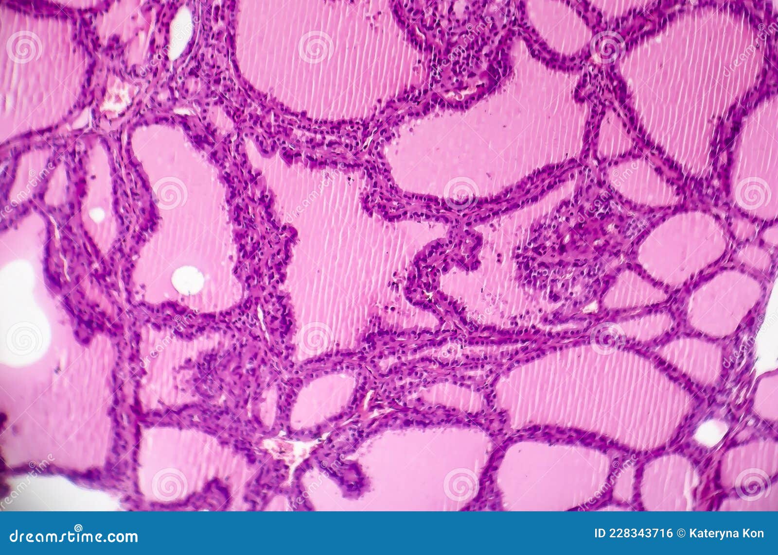 toxic diffuse goiter, or graves' disease, light micrograph