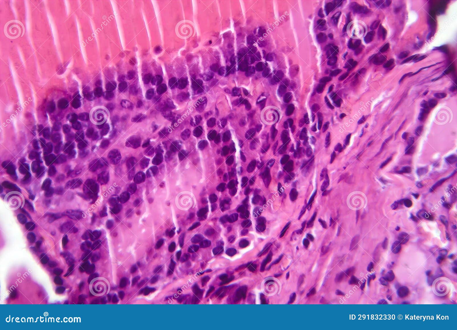 toxic goiter, light micrograph