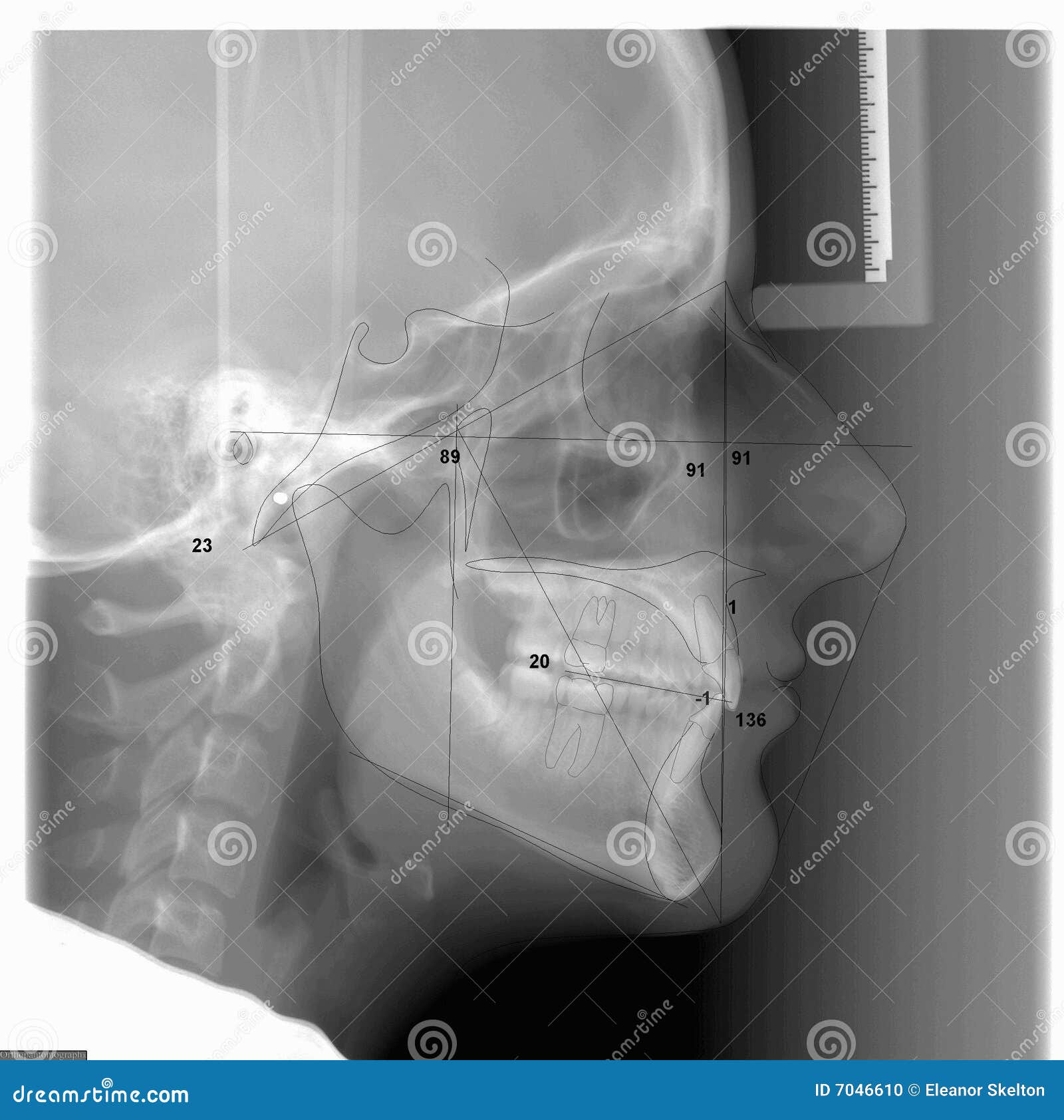 A Traced Cephalometric Xray Stock Photo Image of orthodontic, ceph
