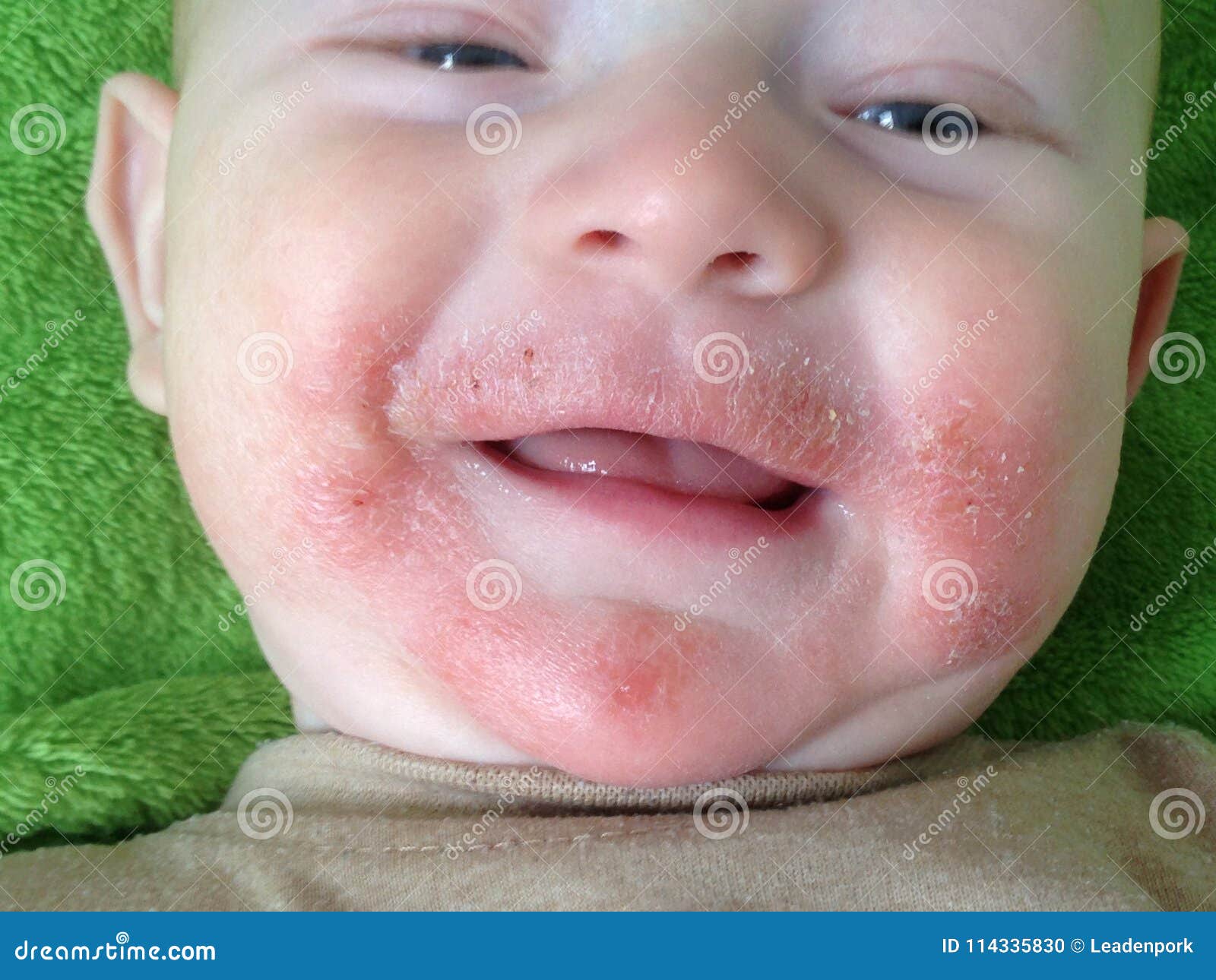 traces of food allergies and atopic dermatitis on the face of the child