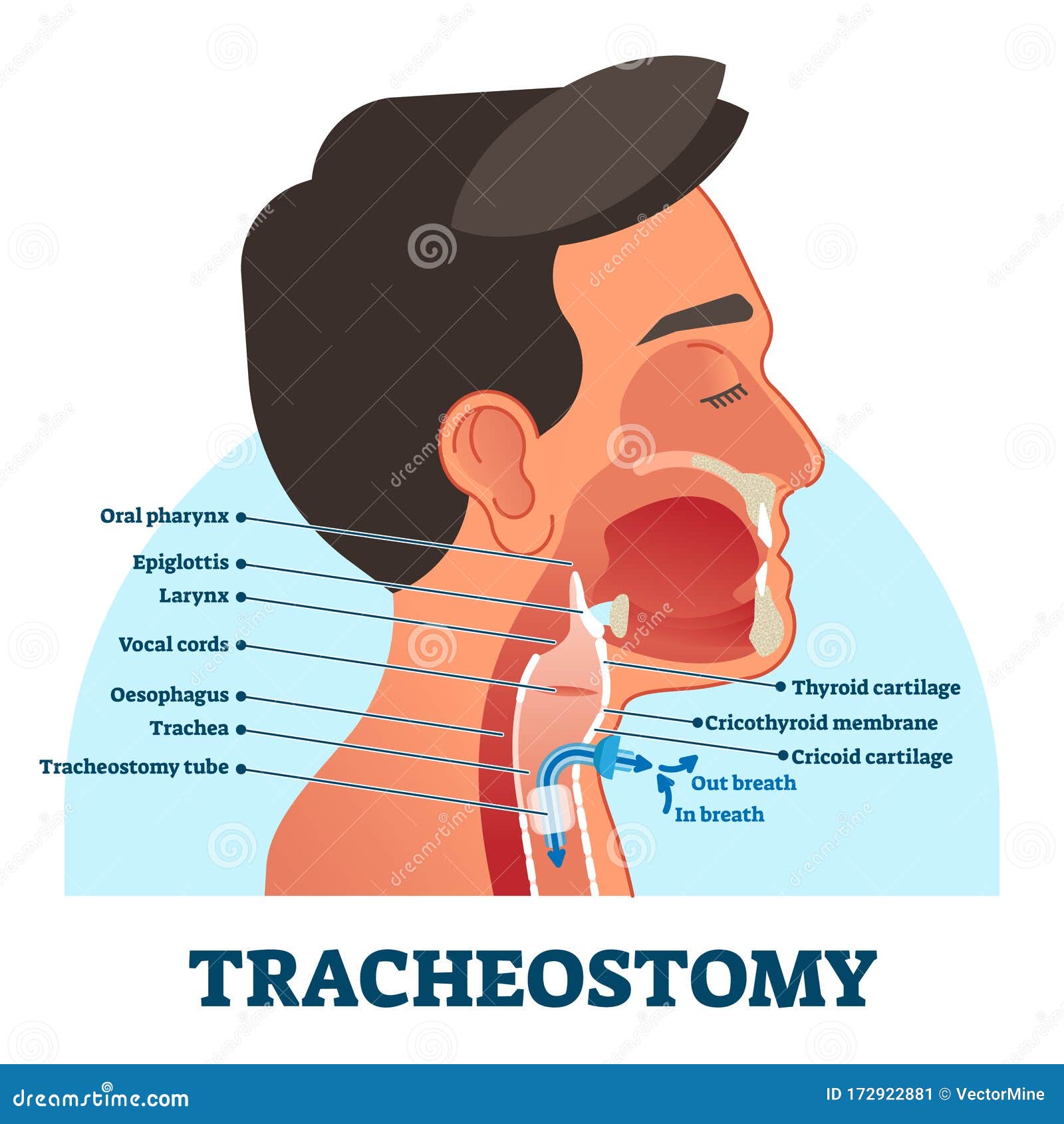 Tracheostomy Cross Section Diagram Vector Illustration Stock Vector Tracheostomy Cross Section Diagram Vector Illustration Stock Vector