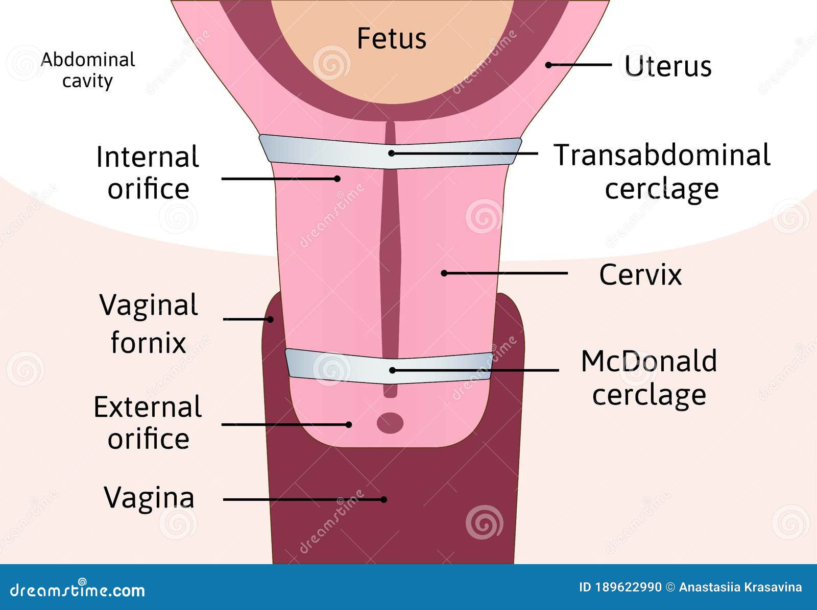 Transabdominal Cerclage Tightening Of Cervix Opening During Pregnancy ...