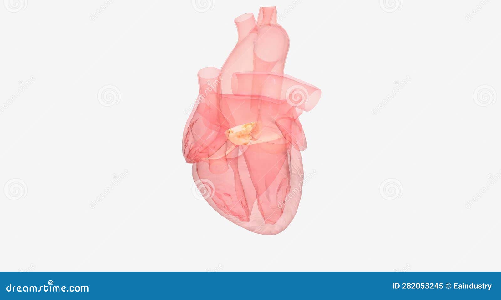 The Transcatheter Aortic Valve Replacement Stock Illustration