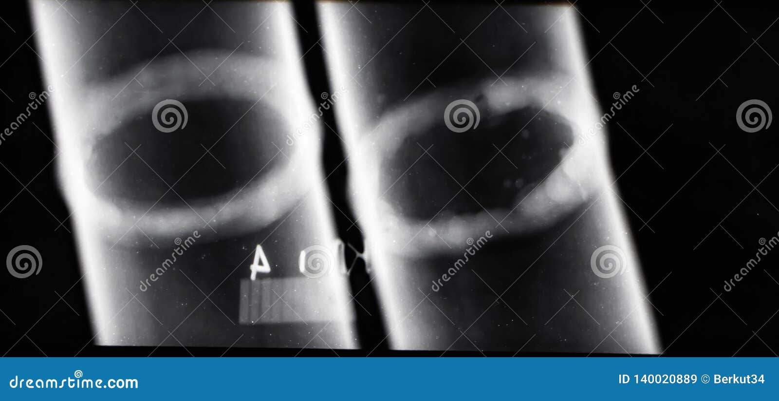 Xray Images Of Welds Of Pipelines To Identify Defective Areas Royalty
