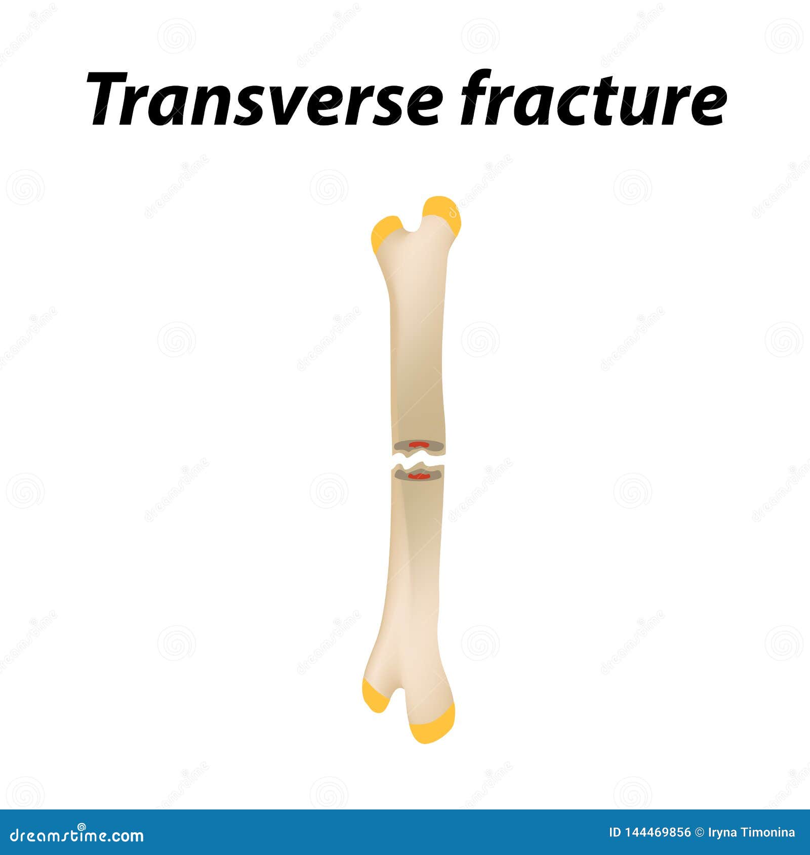Transverse Bone Fracture. Infographics. Vector Illustration on a Lined