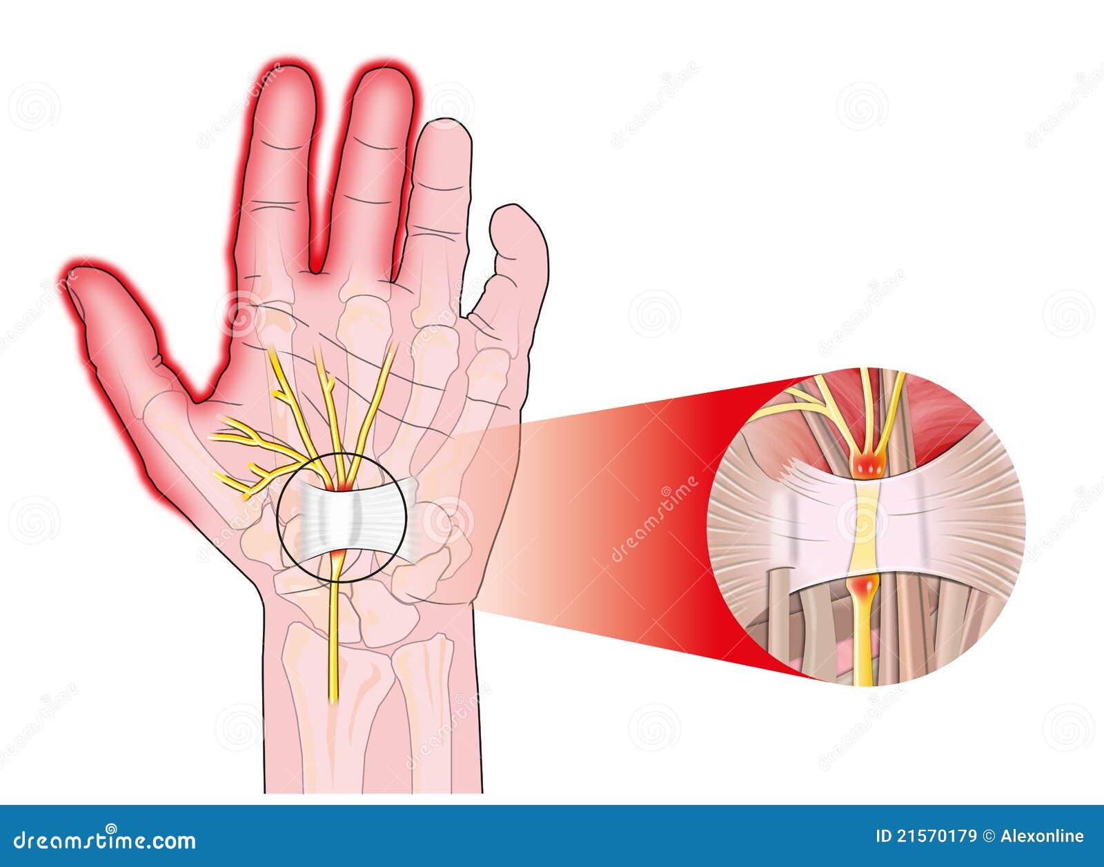 transverse carpal ligament