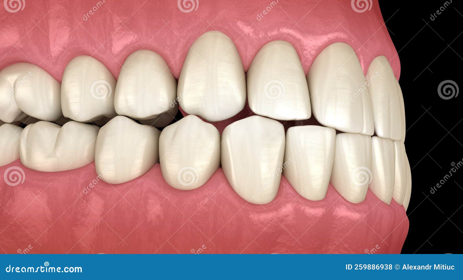 Traumatic Occlusion. Medically Accurate 3D Illustration Stock