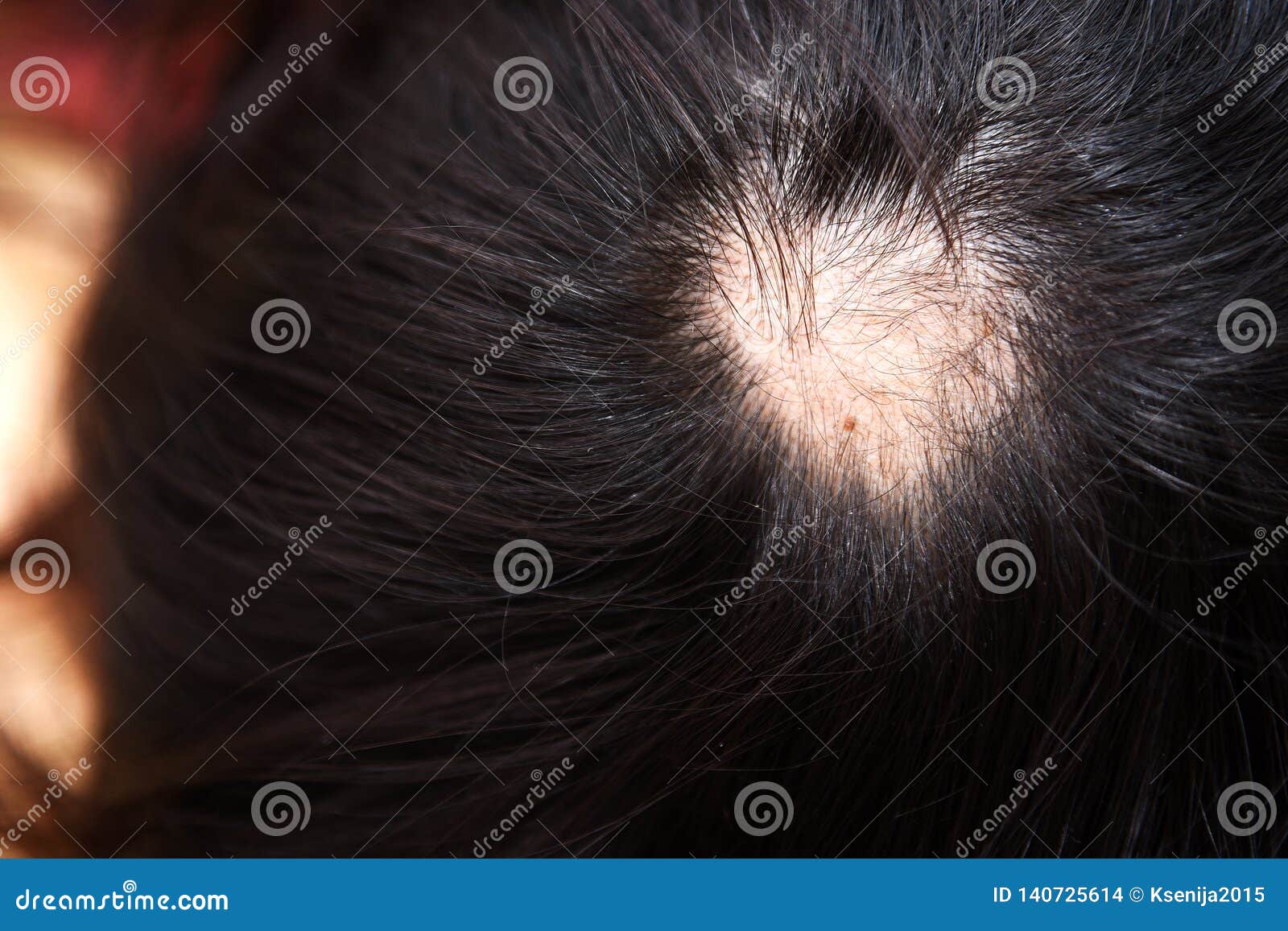 treatment of baldness with beauty injections.
