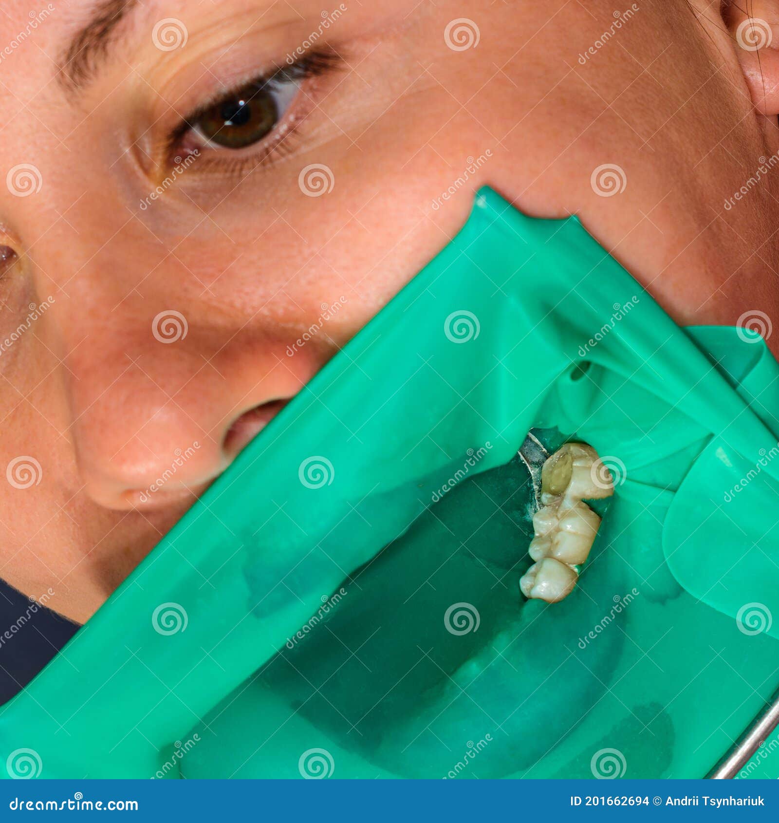 Treatment of a Chewing Tooth, the Dentist Put a Rubber Dam, Uses