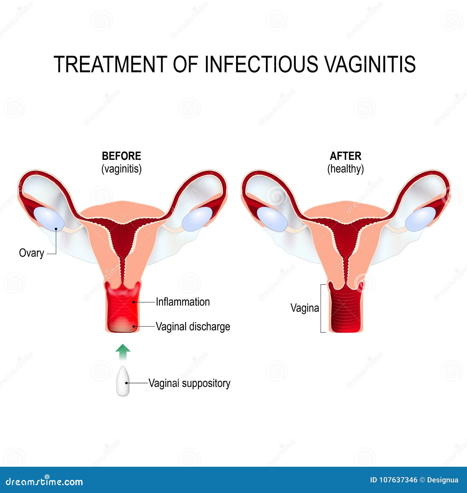 treatment of infectious vaginitis