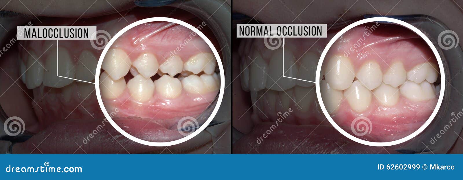 Treatment Malocclusion before and after Stock Image Image of medical