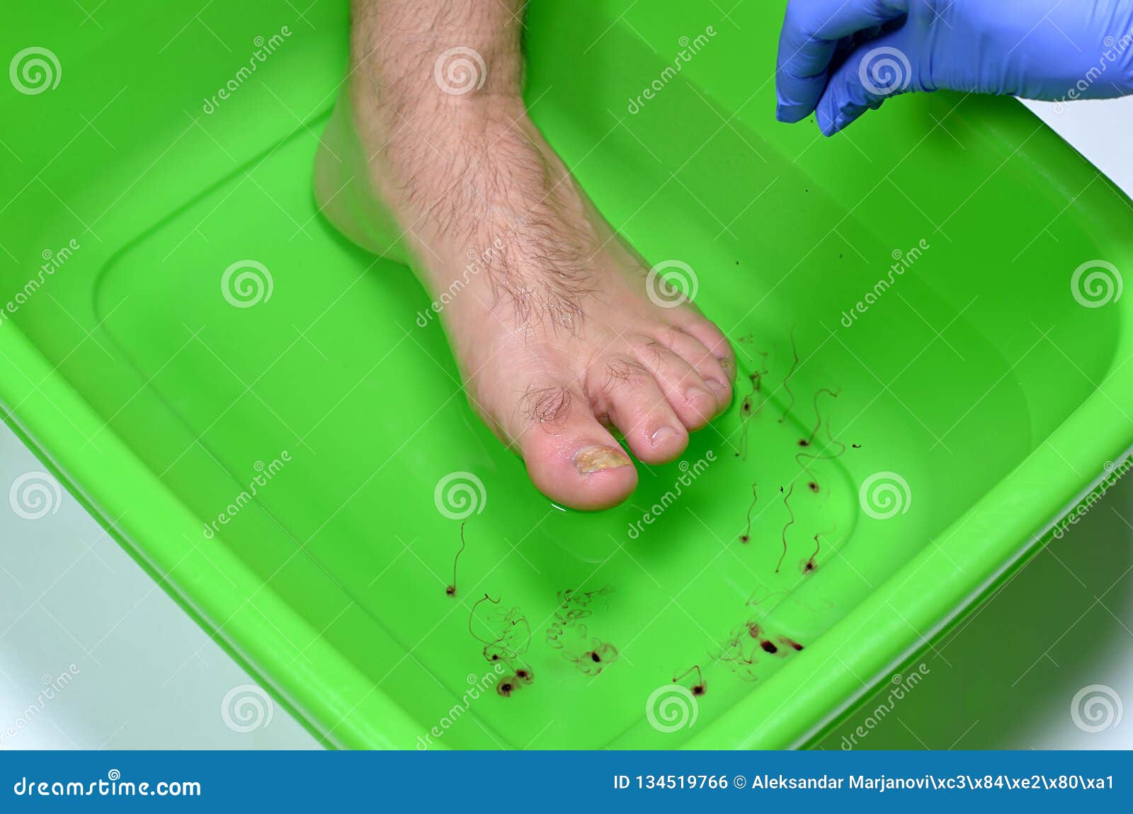 medicine foot nail küzdelem