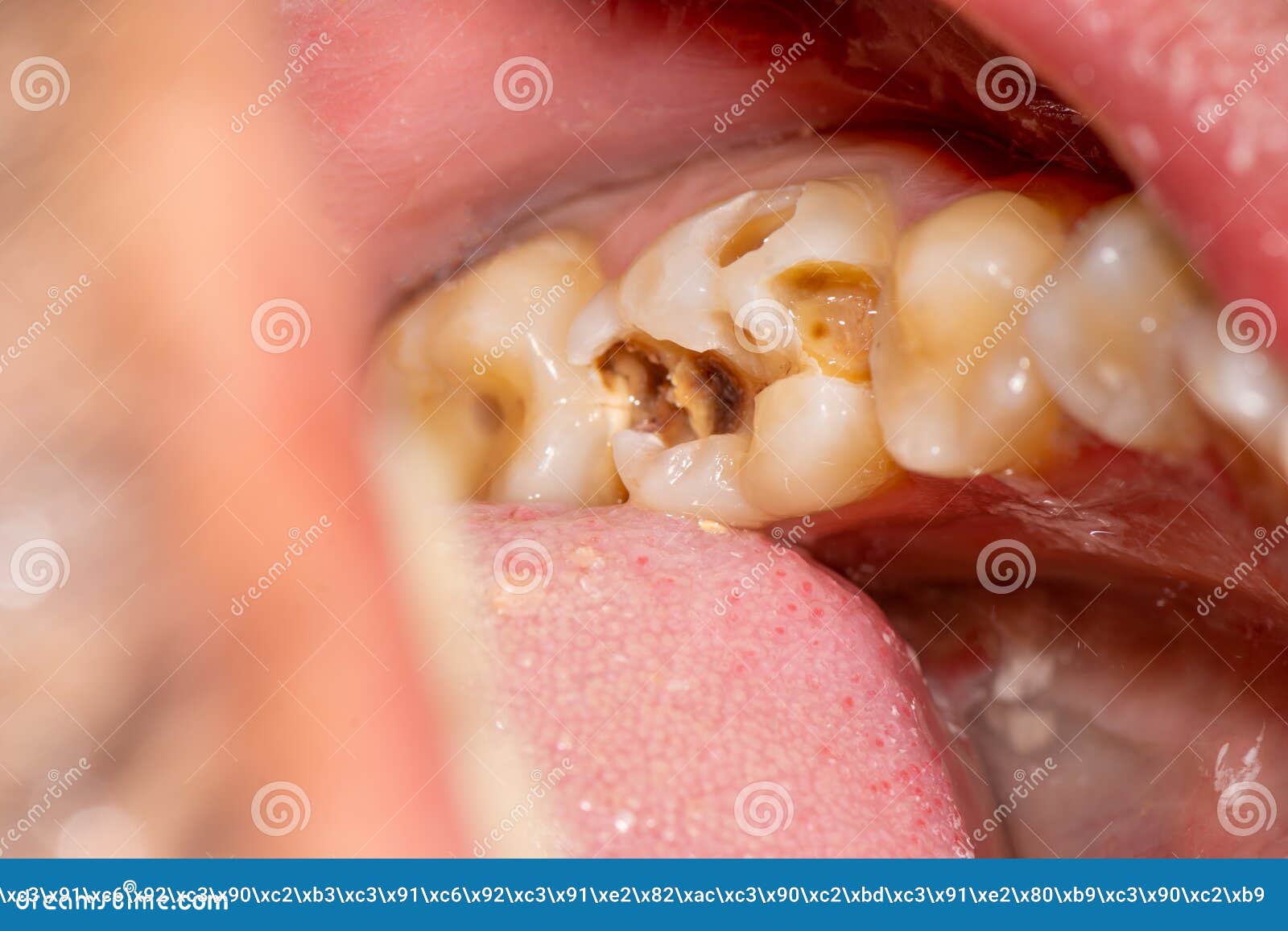 treatment of tooth decay with subsequent filling with photopolymer material. close-up, macro