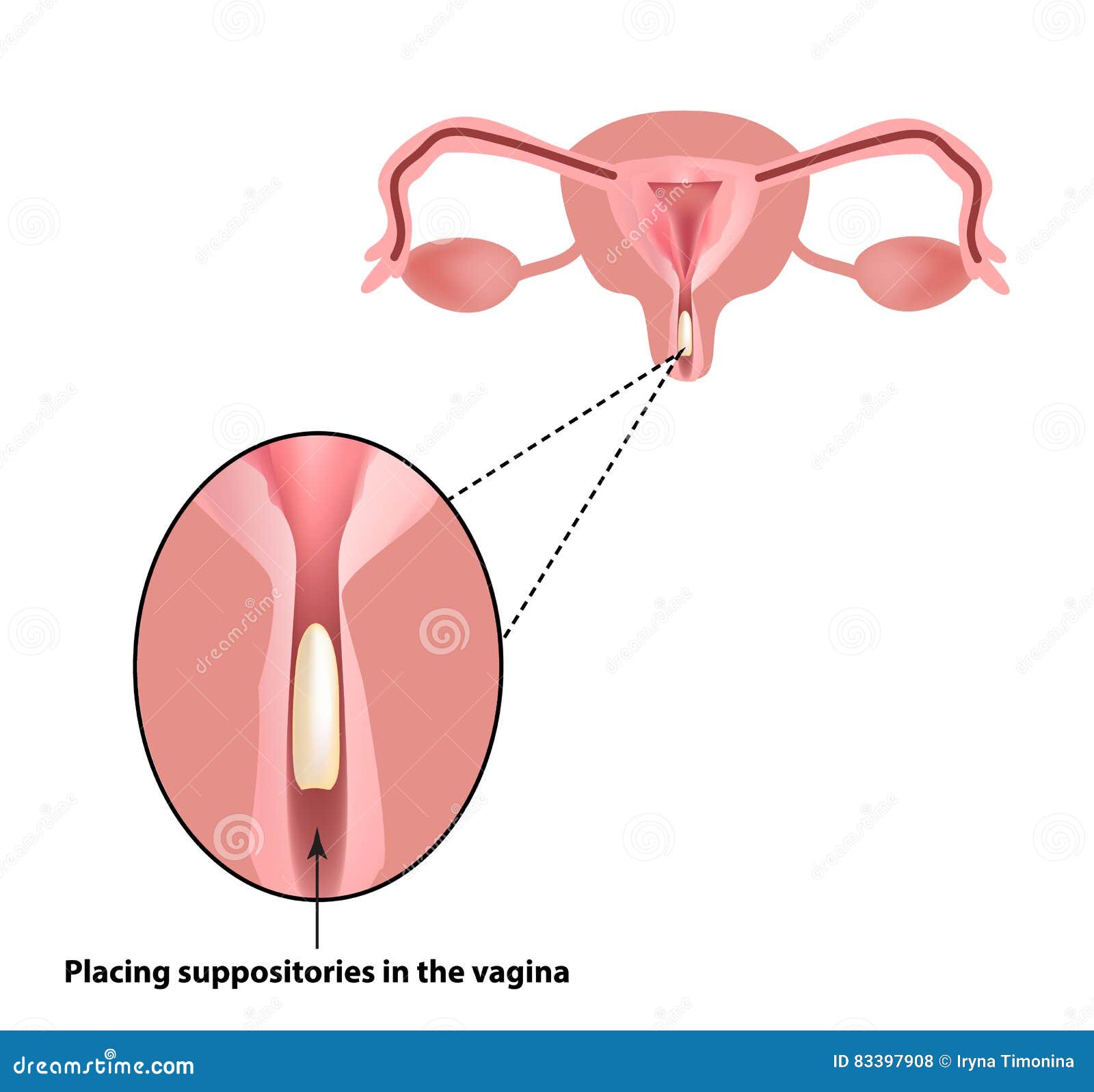 treatment of vaginitis suppositories. inflammation the vagina. infographics.   on  background