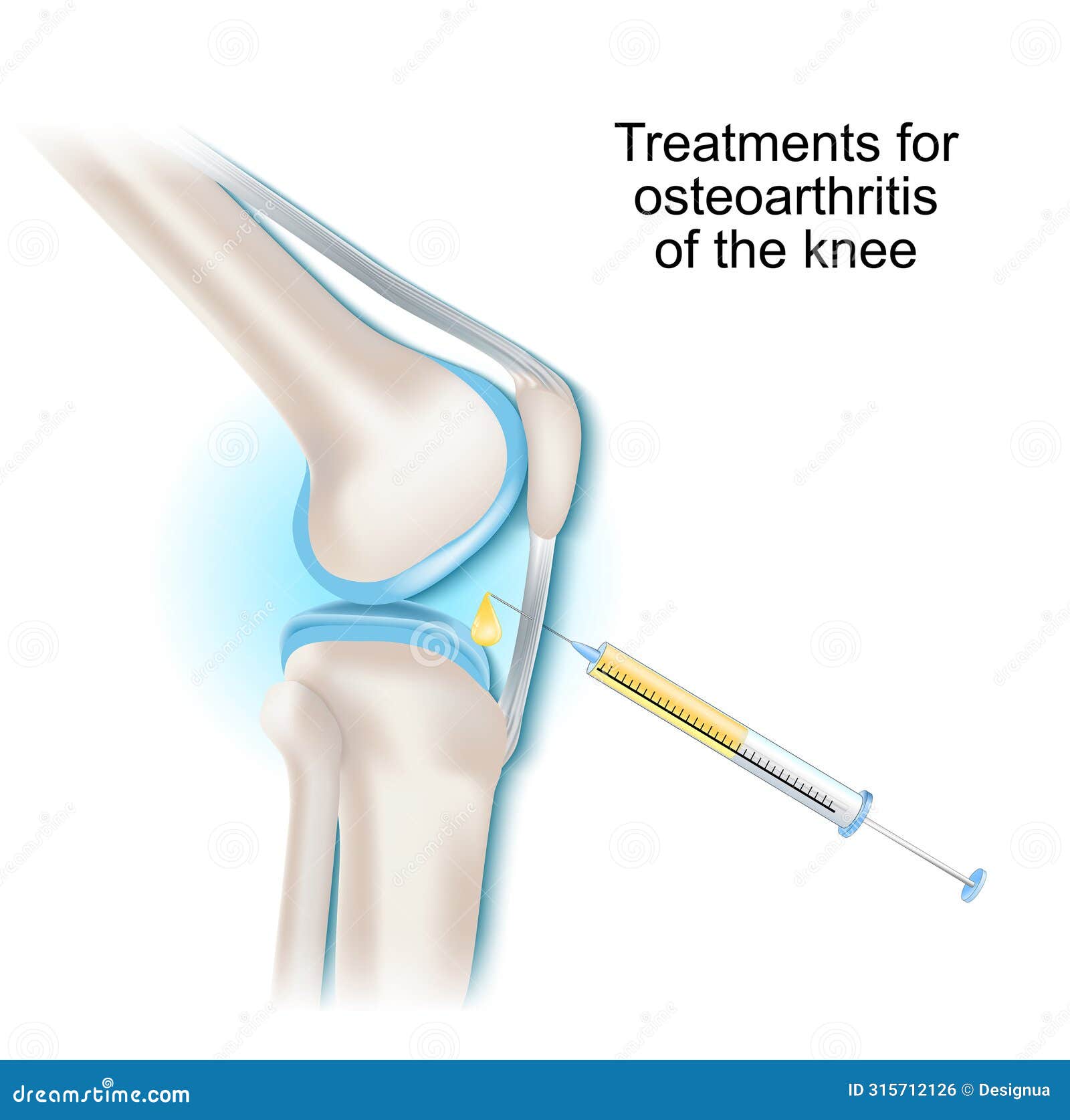 treatments for osteoarthritis of the knee joint