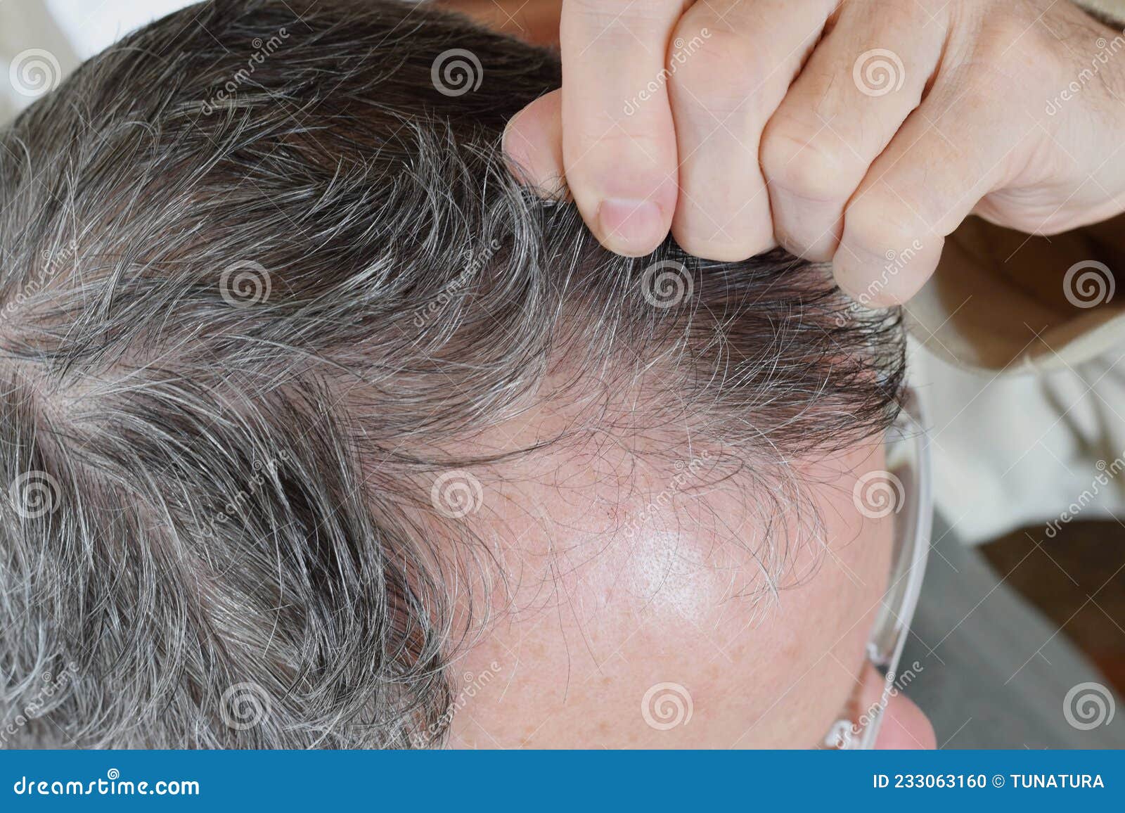 Trichotillomania, Human Impulse Behavioral Problem,hair Pulling