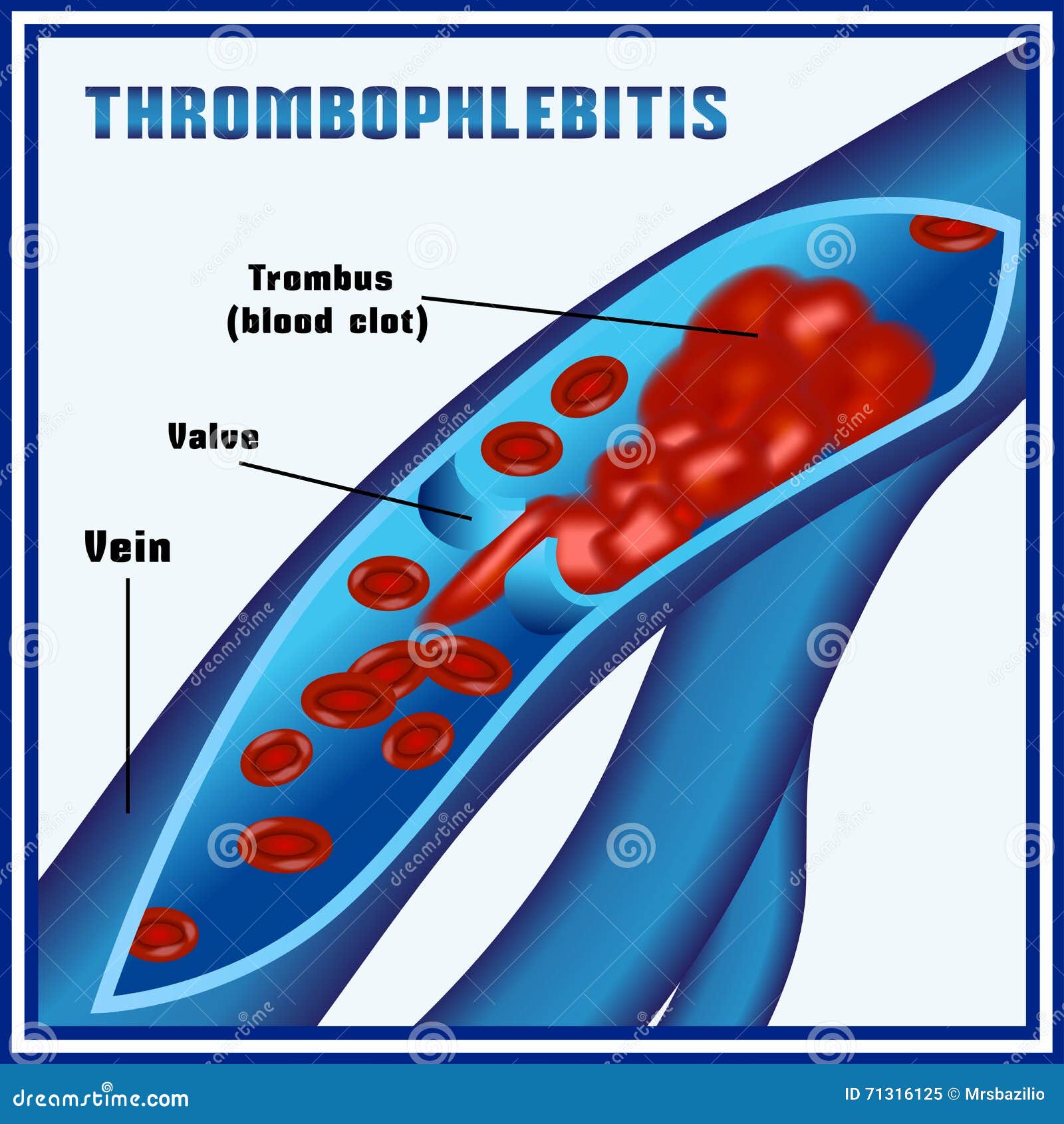 Tratamentul cu tromboflebită varicosera